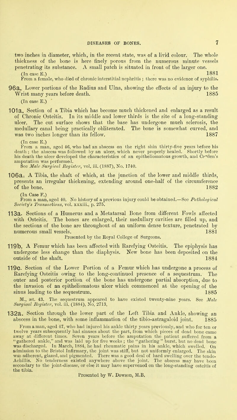 two inches in diameter, which, in the recent state, was of a livid colour. The whole thickness of the bone is here finely porous from the numerous minute vessels penetrating its substance. A small patch is situated in front of the larger one. (In case E.) 1881 From a female, who died of chronic interstitial nephritis ; there was no evidence of syphilis. 96a. Lower portions of the Radius and Ulna, showing the effects of an injury to the Wrist many years before death. 1885 (In case E.) 101a. Section of a Tibia which has become much thickened and enlarged as a result of Chronic Osteitis. In its middle and lower thirds is the site of a long-standing ulcer. The cut surface shows that the base has undergone much sclerosis, the medullary canal being practically obliterated. The bone is somewhat curved, and was two inches longer than its fellow. 1887 (In case E.) From a man, aged 46, who had an abscess on the right shin thirty-five years before his death ; the abscess was followed by an ulcer, which never properly healed. Shortly before his death the ulcer developed the characteristics of an epitheliomatous growth, and Cp^den's amputation was performed. See Male Surgical Register, vol. iii. (1887), No. 1740. 106a; A Tibia, the shaft of which, at the junction of the lower and middle thirds, presents an irregular thickening, extending around one-half of the circumference of the bone. 1882 (In Case F.) From a man, aged 40. No history of a previous injury could be obtained.—Sec Pathological Society's Transactions, vol. xxxiii., p. 275. 113a. Sections of a Humerus and a Metatarsal Bone from different Fowls affected with Osteitis. The bones are enlarged, their medullary cavities are filled up, and the sections of tlie bone are throughout of an uniform dense texture, penetrated by numerous small vessels. 1881 Presented by the Eoyal College of Surgeons. 119b. A Femur which has been affected with Rarefying Osteitis. The epiphysis has undergone less change than the diaphysis. New bone has been deposited on the outside of the shaft, 1884 119c. Section of the Lower Portion of a Femur which has undergone a process of Rarefying Osteitis owing to the long-continued presence of a sequestrum. The outer and posterior portion of the bone has undergone partial absorption, due to the invasion of an epitheliomatous ulcer which commenced at the opening of the sinus leading to the sequestrum. 1885 M., aet. 43. The sequestrum appeared to have existed twenty-nine years. See Male Surgical Register, vol. iii. (1884), No. 2713. 132a. Section through the lower part of the Left Tibia and Ankle, showing an abscess in the bone, with some inflammation of the tibio-astragaloid joint. 1885 From a man,-aged 47, who had injured his ankle thirty years previously, and who for ten or twelve years subsequently had sinuses about the part, from which pieces of dead bone came away at different times. Seven years before the amputation the patient suffered from a gathered ankle, and was laid up for five weeks ; the gathering burst, but no dead bone was discharged. In March, 1884, he had rheumatic pains in his ankle, which swelled. On admission to the Bristol Infirmary, the joint was stiff, but not uniformly enlarged. The skin wat adherent, glazed, and pigmented. There was a good deal of hard swelling over the tendo- Achillis. No tenderness existed anywhere above the joint. The abscess may have been secondary to the joint-disease, or else it may have supervened on the long-standing osteitis of the tibia. Presented by W. Dowson, M.B.