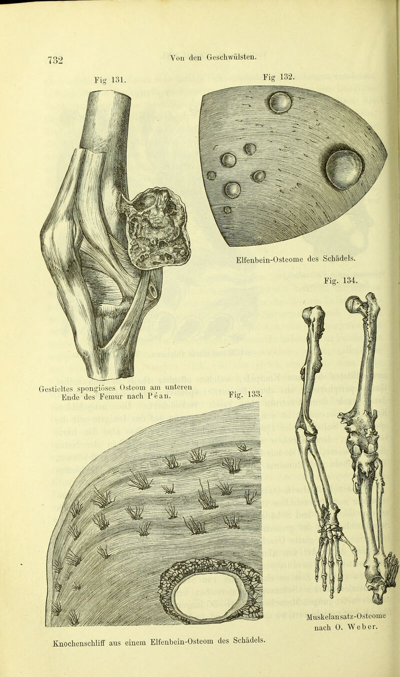 Fig 131. Fig 132. Elfenbein-Osteome des Schädels. Fig. 134. Gestieltes spongioses Osteom arn unteren Ende des Femur nach Pean. Fig. 133. Knochenschliff aus einem Elfenbein-Osteom des Schädels. Muskelansatz-Osteome nach ü. Weber.