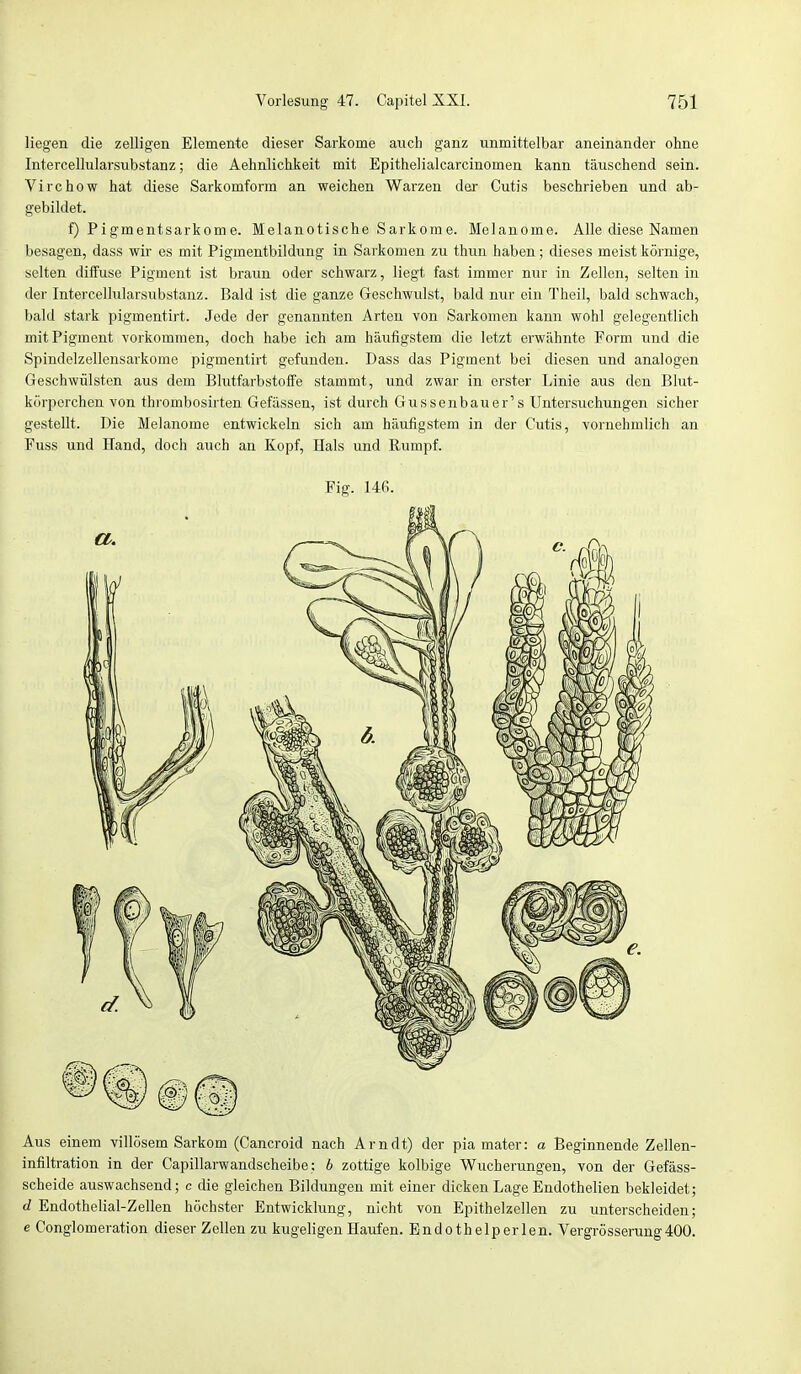 liegen die zelligen Elemente dieser Sarkome auch ganz unmittelbar aneinander ohne Intercellularsubstanz; die Aehnlichkeit mit Epithelialcarcinomen kann täuschend sein. Virchow hat diese Sarkomform an weichen Warzen der Cutis beschrieben und ab- gebildet. f) Pigmentsarkome. Melanotische Sarkome. Melanome. Alle diese Namen besagen, dass wir es mit Pigmentbildung in Sarkomen zu thun haben; dieses meist körnige, selten diffuse Pigment ist braun oder schwarz, liegt fast immer nur in Zellen, selten in der Intercellularsubstanz. Bald ist die ganze Geschwulst, bald nur ein Theil, bald schwach, bald stark pigmentirt. Jede der genannten Arten von Sarkomen kann wohl gelegentlich mit Pigment vorkommen, doch habe ich am häufigstem die letzt erwähnte Form und die Spindelzellensarkome pigmentirt gefunden. Dass das Pigment bei diesen und analogen Geschwülsten aus dem Blutfarbstoffe stammt, und zwar in erster Linie aus den Blut- körperchen von thrombosirten Gefässen, ist durch Gussenbauer's Untersuchungen sicher gestellt. Die Melanome entwickeln sich am häufigstem in der Cutis, vornehmlich an Fuss und Hand, doch auch an Kopf, Hals und Rumpf. Fig. 146. Aus einem villösem Sarkom (Cancroid nach Arndt) der pia mater: a Beginnende Zellen- infiltration in der Capillarwandscheibe: b zottige kolbige Wucherungen, von der Gefäss- scheide auswachsend; c die gleichen Bildungen mit einer dicken Lage Endothelien bekleidet; d Endothelial-Zellen höchster Entwicklung, nicht von Epithelzellen zu unterscheiden; e Conglomeration dieser Zellen zu kugeligen Haufen. Endothelperlen. Vergrösserung400.