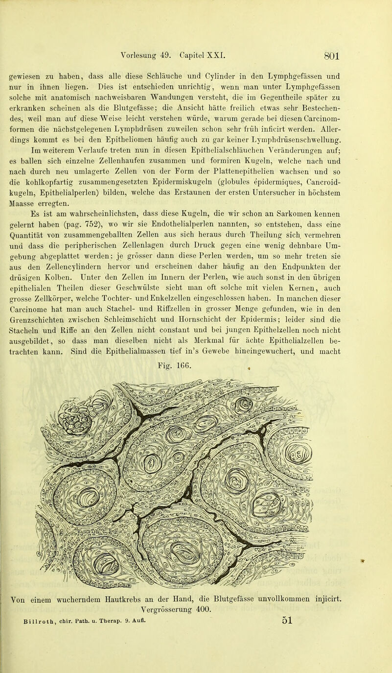 gewiesen zu haben, dass alle diese Schläuche und Cylinder in den Lymphgefässen und nur in ihnen liegen. Dies ist entschieden unrichtig, wenn man unter Lymphgefässen solche mit anatomisch nachweisbaren Wandungen versteht, die im Gegentheile später zu erkranken scheinen als die Blutgefässe; die Ansicht hätte freilich etwas sehr Bestechen- des, weil man auf diese Weise leicht verstehen würde, warum gerade bei diesen Carcinom- formen die näcbstgelegenen Lymphdrüsen zuweilen schon sehr früh inficirt werden. Aller- dings kommt es bei den Epitheliomen häufig' auch zu gar keiner Lymphdrüsenschwellung. Im weiterem Verlaufe treten nun in diesen Epithelialschläuchen Veränderungen auf; es ballen sich einzelne Zellenhaufen zusammen und formiren Kugeln, welche nach und nach durch neu umlagerte Zellen von der Form der Plattenepithelien wachsen und so die kohlkopfartig zusammengesetzten Epidermiskugeln (globules epidermiques, Cancroid- kugeln, Epithelialperlen) bilden, welche das Erstaunen der ersten Untersucher in höchstem Maasse erregten. Es ist am wahrscheinlichsten, dass diese Kugeln, die wir schon an Sarkomen kennen gelernt haben (pag. 752), wo wir sie Endothelialperlen nannten, so entstehen, dass eine Quantität von zusammengeballten Zellen aus sich heraus durch Theilung sich, vermehren und dass die peripherischen Zellenlagen durch Druck gegen eine wenig dehnbare Um- gebung abgeplattet werden : je grösser dann diese Perlen werden, um so mehr treten sie aus den Zellencylindern hervor und erscheinen daher häufig an den Endpunkten der drüsigen Kolben. Unter den Zellen im Innern der Perlen, wie auch sonst in den übrigen epithelialen Theilen dieser Geschwülste sieht man oft solche mit vielen Kernen, auch grosse Zellkörper, welche Tochter- und Enkelzellen eingeschlossen haben. In manchen dieser Carcinome hat man auch Stachel- und Riffzellen in grosser Menge gefunden, wie in den Grenzschichten zwischen Schleimschicht und Hornschicht der Epidermis; leider sind die Stacheln und Riffe an den Zellen nicht constant und bei jungen Epithelzellen noch nicht ausgebildet, so dass man dieselben nicht als Merkmal für ächte Epithelialzellen be- trachten kann. Sind die Epithelialmassen tief in's Gewebe hineingewuchert, und macht Fig. 166. , Von einem wucherndem Hautkrebs an der Hand, die Blutgefässe unvollkommen injicirt. Vergrösserung 400. Billroth, chir. Path. u. Therap. 9. Aufl. 51