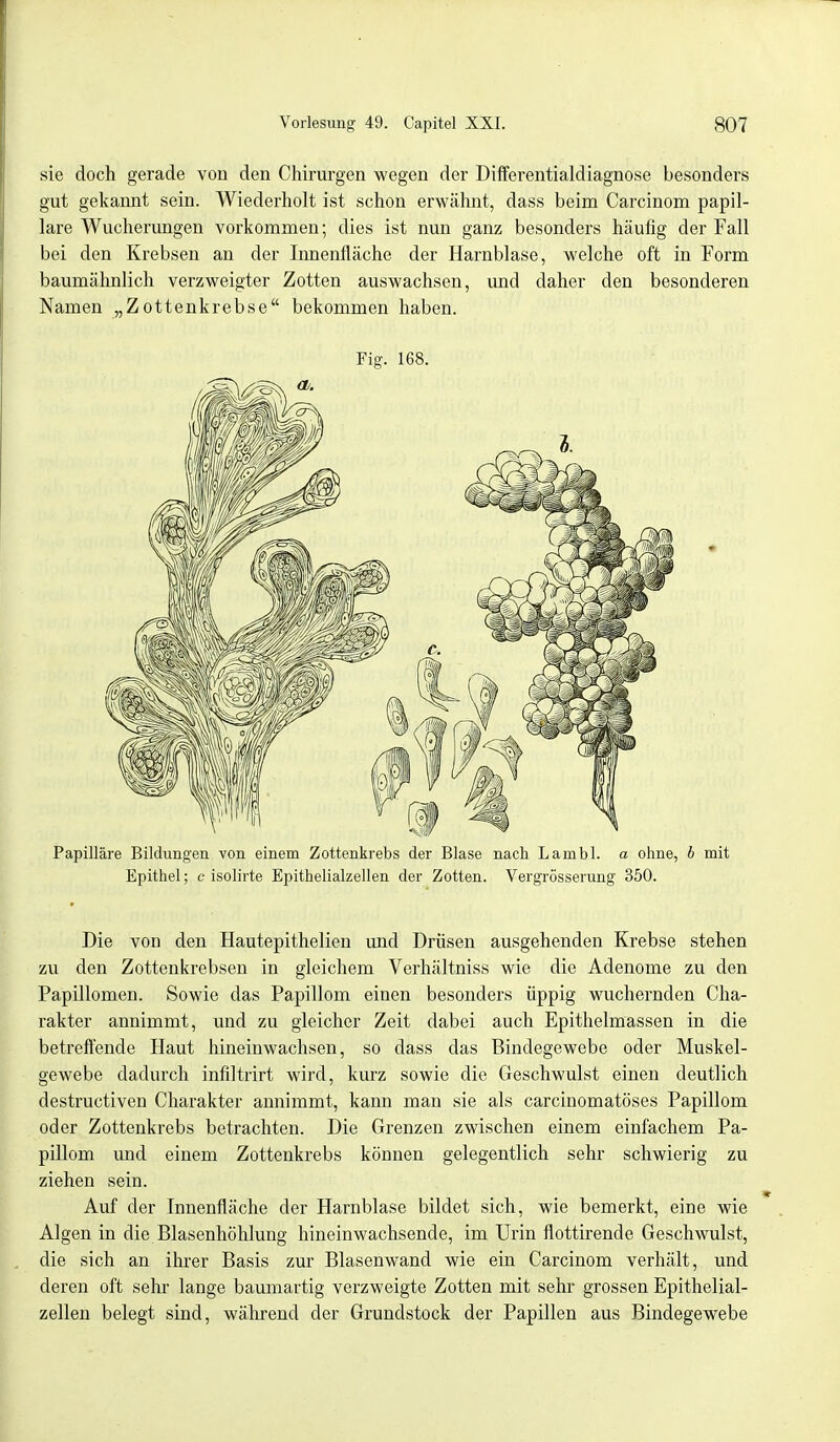 sie doch gerade von den Chirurgen wegen der Differentialdiagnose besonders gut gekannt sein. Wiederholt ist schon erwähnt, dass beim Carcinom papil- läre Wucherungen vorkommen; dies ist nun ganz besonders häufig der Fall bei den Krebsen an der Innenfläche der Harnblase, welche oft in Form baumähnlich verzweigter Zotten auswachsen, und daher den besonderen Namen „Zottenkrebse bekommen haben. Fig. 168. Papilläre Bildungen von einem Zottenkrebs der Blase nach Lambl. a ohne, b mit Epithel; c isolirte Epithelialzellen der Zotten. Vergrösserung 350. Die von den Hautepithelien und Drüsen ausgehenden Krebse stehen zu den Zottenkrebsen in gleichem Verhältniss wie die Adenome zu den Papillomen. Sowie das Papillom einen besonders üppig wuchernden Cha- rakter annimmt, und zu gleicher Zeit dabei auch Epithelmassen in die betreffende Haut hineinwachsen, so dass das Bindegewebe oder Muskel- gewebe dadurch infiltrirt wird, kurz sowie die Geschwulst einen deutlich destructiven Charakter annimmt, kann man sie als carcinomatöses Papillom oder Zottenkrebs betrachten. Die Grenzen zwischen einem einfachem Pa- pillom und einem Zottenkrebs können gelegentlich sehr schwierig zu ziehen sein. Auf der Innenfläche der Harnblase bildet sich, wie bemerkt, eine wie Algen in die Blasenhöhlung hineinwachsende, im Urin flottirende Geschwulst, die sich an ihrer Basis zur Blasenwand wie ein Carcinom verhält, und deren oft sehr lange baumartig verzweigte Zotten mit sehr grossen Epithelial- zellen belegt sind, während der Grundstock der Papillen aus Bindegewebe