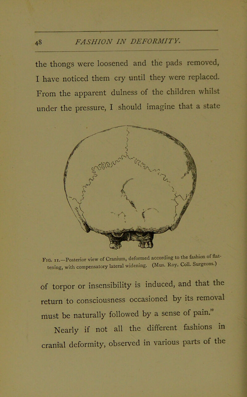 the thongs were loosened and the pads removed, I have noticed them cry until they were replaced. From the apparent dulness of the children whilst under the pressure, I should imagine that a state Fig. ii.—Posterior view of Cranium, deformed according to the fashion of flat- tening, with compensatory lateral widening. (Mus. Roy. Coll. Surgeons.) of torpor or insensibility is induced, and that the return to consciousness occasioned by its removal must be naturally followed by a sense of pain. Nearly if not all the different fashions in cranial deformity, observed in various parts of the