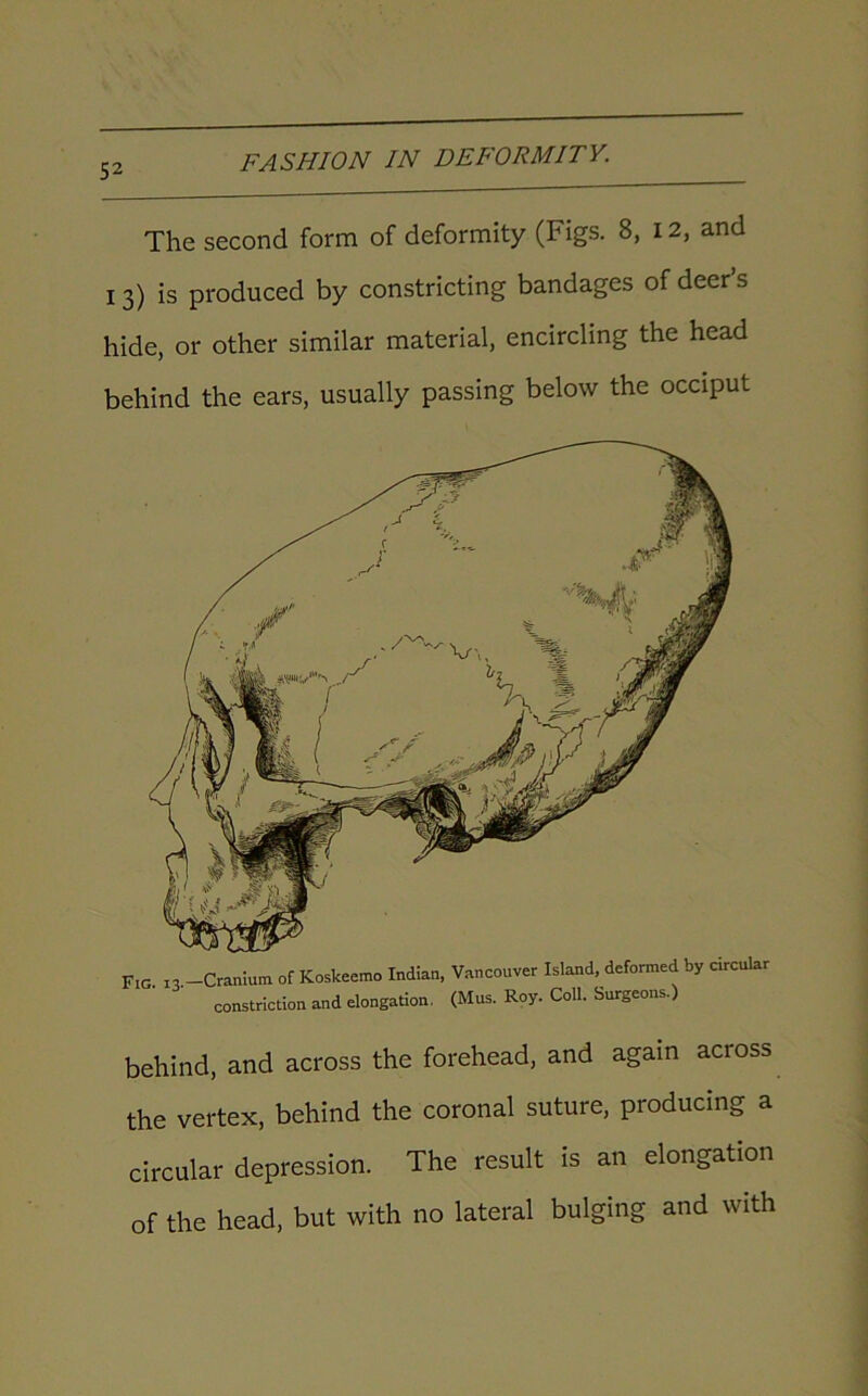 The second form of deformity (Figs. 8, 12, and 13) is produced by constricting bandages of deer’s hide, or other similar material, encircling the head behind the ears, usually passing below the occiput Fig 13 -Cranium of Koskeemo Indian, Vancouver Island, deformed by circular constriction and elongation. (Mus. Roy. Coll. Surgeons.) behind, and across the forehead, and again across the vertex, behind the coronal suture, producing a circular depression. The result is an elongation of the head, but with no lateral bulging and with