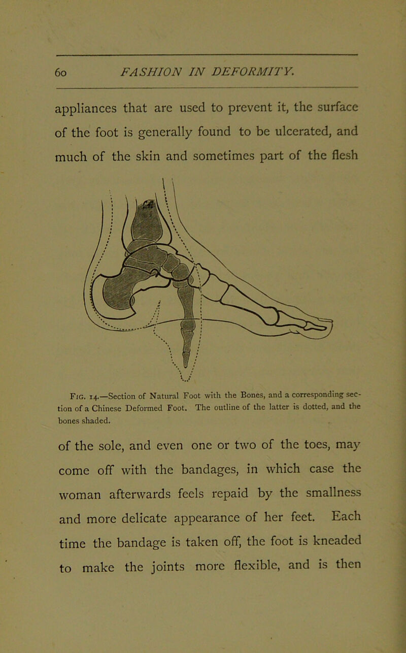 appliances that are used to prevent it, the surface of the foot is generally found to be ulcerated, and much of the skin and sometimes part of the flesh Fig. 14.—Section of Natural Foot with the Bones, and a corresponding sec- tion of a Chinese Deformed Foot. The outline of the latter is dotted, and the bones shaded. of the sole, and even one or two of the toes, may come off with the bandages, in which case the woman afterwards feels repaid by the smallness and more delicate appearance of her feet. Each time the bandage is taken off, the foot is kneaded to make the joints more flexible, and is then
