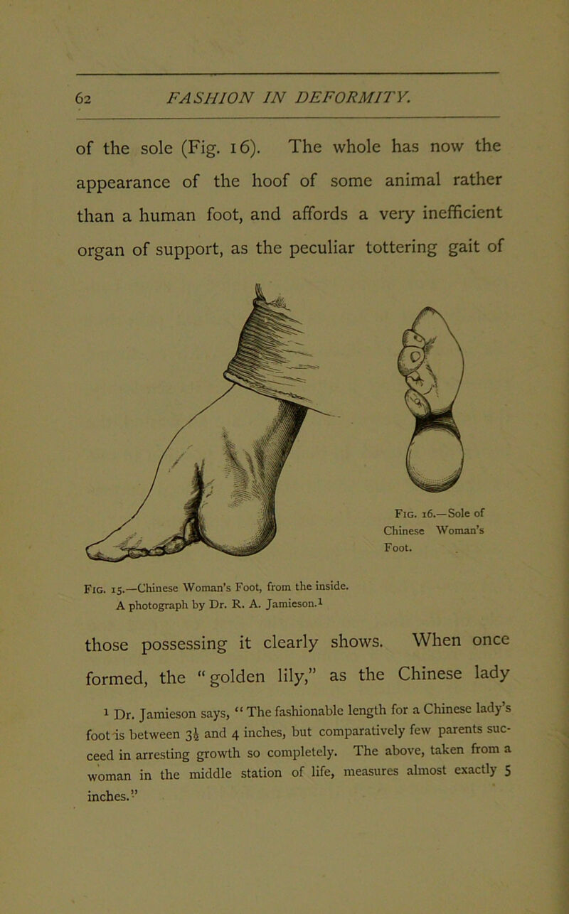 of the sole (Fig. 16). The whole has now the appearance of the hoof of some animal rather than a human foot, and affords a very inefficient organ of support, as the peculiar tottering gait of Fig. 15.—Chinese Woman’s Foot, from the inside. A photograph by Dr. R. A. Jamieson.1 those possessing it clearly shows. When once formed, the “golden lily,” as the Chinese lady 1 Dr. Jamieson says, “ The fashionable length for a Chinese lady’s foot is between 3^ and 4 inches, but comparatively few parents suc- ceed in arresting growth so completely. The above, taken from a woman in the middle station of life, measures almost exactly 5 inches.”