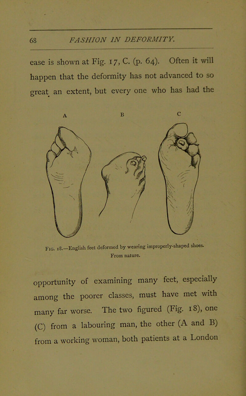 ease is shown at Fig. 17, C. (p. 64). Often it will happen that the deformity has not advanced to so great an extent, but every one who has had the a b c Fig. 18.—English feet deformed by wearing improperly-shaped shoes. From nature. opportunity of examining many feet, especially among the poorer classes, must have met with many far worse. The two figured (Fig. 18), one (C) from a labouring man, the other (A and B) from a working woman, both patients at a London