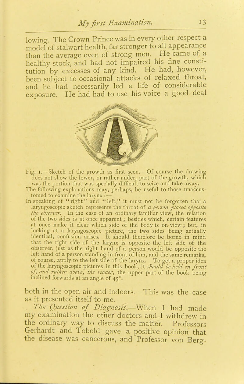 lowing. The Crown Prince was in every other respect a model of stalwart health, far stronger to all appearance than the average even of strong men. He came of a healthy stock, and had not impaired his fine consti- tution by excesses of any kind. He had, however, been subject to occasional attacks of relaxed^ throat, and he had necessarily led a life of considerable exposure. He had had to use his voice a good deal Fig. I.—Sketch of the growth as first seen. Of course the drawing does not show the lower, or rather under, part of the growth, which was the portion that was specially difficult to seize and take away. The following explanations may, perhaps, be useful to those unaccus- tomed to examine the larynx :— In speaking of “right” and “left,” it must not be forgotten that a laryngoscopic sketch represents the throat of a person placed opposite the obsen<er. In the case of an ordinary familiar view, the relation of the two sides is at once apparent; besides which, certain features at once make it clear which side of the body is on view; but, in looking at a laryngoscopic picture, the two sides being actually identical, confusion arises. It should therefore be borne in mind that the right side of the larynx is opposite the left side of the observer, just as the right hand of a person would be opposite the left hand of a person standing in front of him, and the same remarks, of course, apply to the left side of the larynx. To get a proper idea of the laryngoscopic pictures in this book, it should be held hi froiit of, and rather above, the reader, the upper part of the book being inclined forwards at an angle of 45°. both in the open air and indoors. This was the case as it presented itself to me. . The Question of Diagnosis.—When I had made my examination the other doctors and I withdrew in the ordinary way to discuss the matter. Professors Gerhardt and Tobold gave a positive opinion that the disease was cancerous, and Professor von Berg-