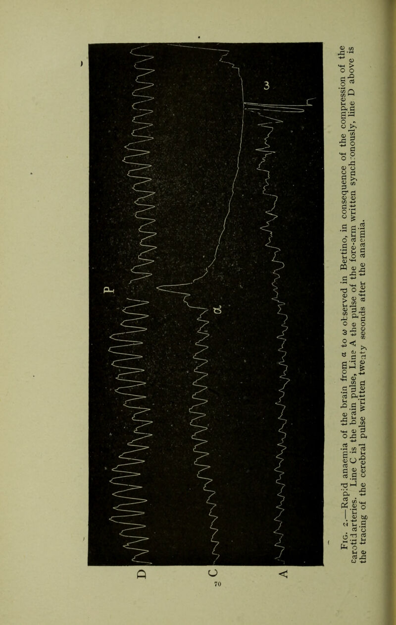 Fig. 2.—Rapid anaemia of the brain from a to u observed in Bertino, in consequence of the compression of the carotid arteries. Line C is the brain pulse. Line A the pulse of the fore-arm written synchronously, line D above is the tracing of the cerebral pulse written twenty seconds after the anaemia.