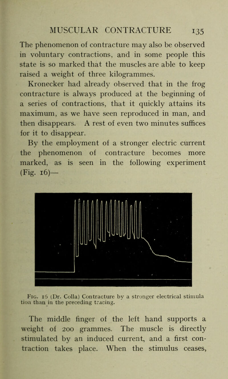 The phenomenon of contracture may also be observed in voluntary contractions, and in some people this state is so marked that the muscles are able to keep raised a weight of three kilogrammes. Kronecker had already observed that in the frog contracture is always produced at the beginning of a series of contractions, that it quickly attains its maximum, as we have seen reproduced in man, and then disappears. A rest of even two minutes suffices for it to disappear. By the employment of a stronger electric current the phenomenon of contracture becomes more marked, as is seen in the following experiment (Fig. 16)— Fig. 16 (Dr. Colla) Contracture by a stronger electrical stimula tion than in the preceding tracing. The middle finger of the left hand supports a weight of 200 grammes. The muscle is directly stimulated by an induced current, and a first con- traction takes place. When the stimulus ceases,