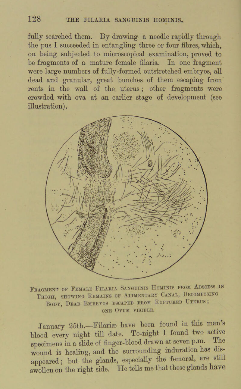 fully searched them. By drawing a needle rapidly through the pus I succeeded in entangling three or four fibres, which, on being subjected to microscopical examination, proved to be fragments of a mature female filaria. In one fragment were large numbers of fully-formed outstretched embryos, all dead and granular, great bunches of them escaping from rents in the wall of the uterus; other fragments were crowded with ova at an earlier stage of development (see illustration). Fragment of Female Filaria Sanguinis Homints from Abscess in Thigh, showing Remains of Alimentary Canal, Decomposing Body, Dead Embryos escaped from Ruptured Uterus; one Ovum visible. January 25th.—Filarise have been found in this man’s blood every night till date. To-night I found two active specimens in a slide of finger-blood drawn at seven p.m. The wound is healing, and the surrounding induration has dis- appeared; but the glands, especially the femoral, are still swollen on the right side. He tells me that these glands have