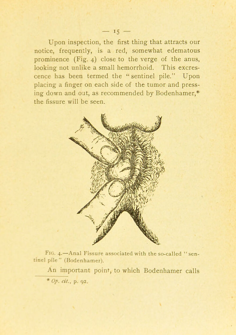 Upon inspection, the first thing that attracts our notice, frequently, is a red, somewhat edematous prominence (Fig. 4) close to the verge of the anus, looking not unlike a small hemorrhoid. This excres- cence has been termed the “sentinel pile.” Upon placing a finger on each side of the tumor and press- ing down and out, as recommended by Bodenhamer,* the fissure will be seen. Fig. 4.—Anal Fissure associated with the so-called “sen- tinel pile” (Bodenhamer). An important point, to which Bodenhamer calls