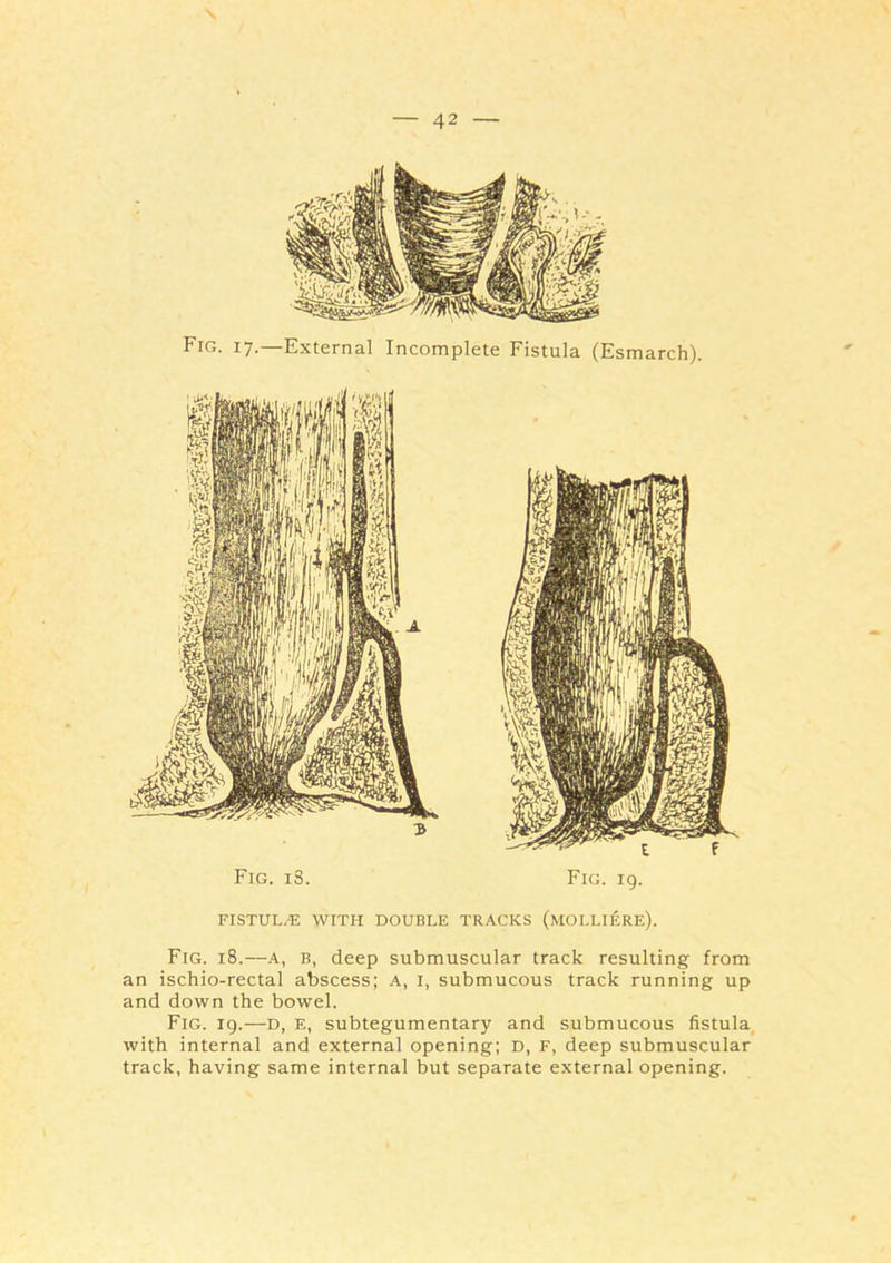 \ — 42 — Fig. 17.—External Incomplete Fistula (Esmarch). Fig. i3. Fig. 19. FISTUL.^: WITH DOUBLE TRACKS (mOLLIERE). Fig. 18.—A, B, deep submuscular track resulting from an ischio-rectal abscess; A, l, submucous track running up and down the bowel. Fig. 19.—D, E, subtegumentary and submucous fistula with internal and external opening; D, F, deep submuscular track, having same internal but separate external opening.
