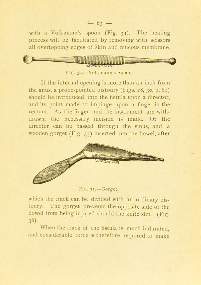 with a Volkmann’s spoon (Fig. 34). The healing process will be facilitated by removing with scissors all overtopping edges of skin and mucous membrane. Fig. 34.—Volkmann’s Spoon. If the internal opening is more than an inch from the anus, a probe-pointed bistoury (Figs. 28, 30, p. 61) should be introduced into the fistula upon a director, and its point made to impinge upon a finger in the rectum. As the finger and the instrument are with- drawn, the necessary incision is made. Or the director can be passed through the sinus, and a wooden gorget (Fig. 35) inserted into the bowel, after Fig. 35.—-Gorget. which the track can be divided with an ordinary bis- toury. The gorget prevents the opposite side of the bowel from being injured should the knife slip. (Fig 36). When the track of the fistula is much indurated, and considerable force is therefore required to make