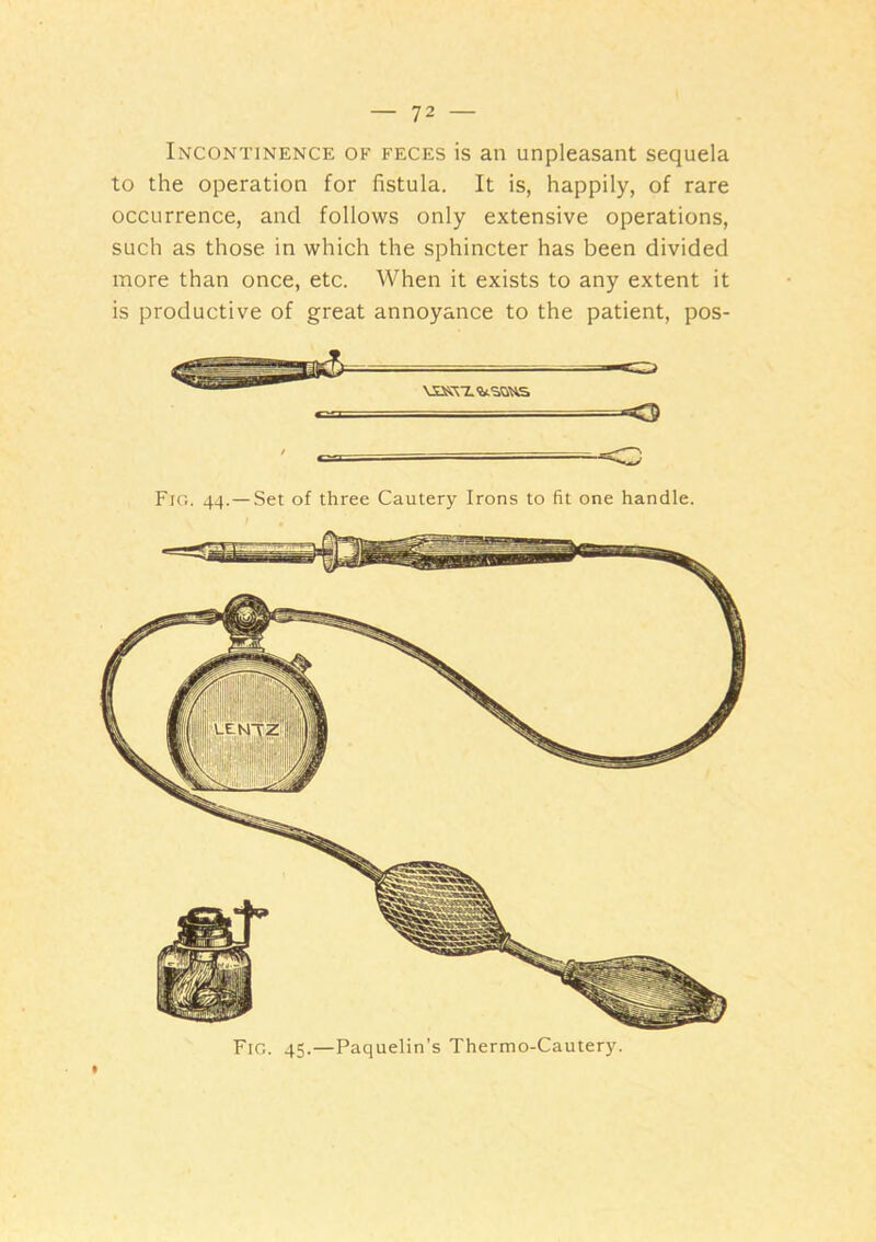 Incontinence of feces is an unpleasant sequela to the operation for fistula. It is, happily, of rare occurrence, and follows only extensive operations, such as those in which the sphincter has been divided more than once, etc. When it exists to any extent it is productive of great annoyance to the patient, pos- Fig. 45.—Paquelin’s Thermo-Cautery. Fig. 44. — Set of three Cautery Irons to fit one handle.