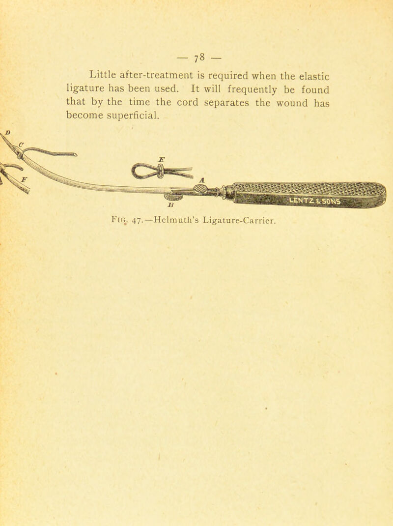 Little after-treatment is required when the elastic ligature has been used. It will frequently be found that by the time the cord separates the wound has become superficial.