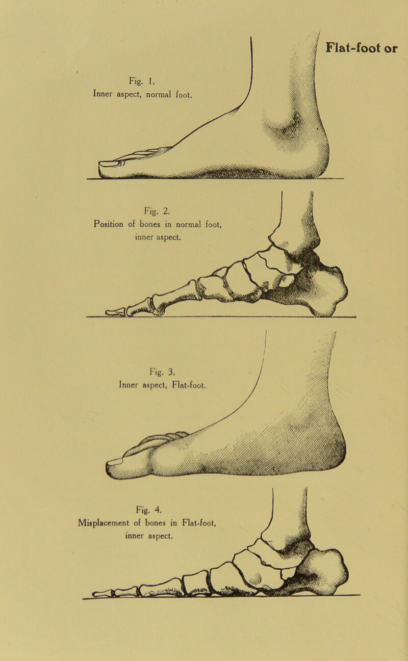 Fig. 2. Position of bones in normal foot, inner aspect.