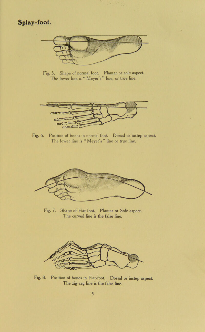Fig. 5. Shape of normal foot. Plantar or sole aspect The lower line is “ Meyer’s  line, or true line. Fig. 6. Position of bones in normal foot. Dorsal or instep aspect. The lower line is “ Meyer’s ” line or true line. Fig. 7. Shape of Fiat foot. Plantar or Sole aspect. The curved line is the false line. Fig. 8. Position of bones in Flat-foot. Dorsal or instep aspect. The zig-zag line is the false line.