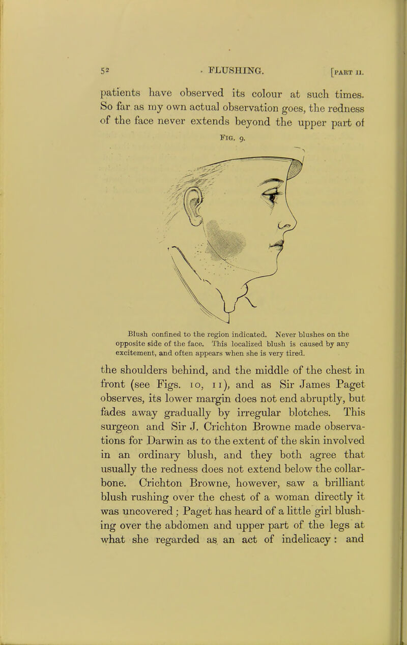 patients have observed its colour at such times. So far as my own actual observation goes, the redness of the face never extends beyond the upper part of Fig. 9. Blush confined to the region indicated. Never blushes on the opposite side of the face. This localized blush is caused by any excitement, and often appears when she is very tired. the shoulders behind, and the middle of the chest in front (see Figs. 10, 11), and as Sir James Paget observes, its lower margin does not end abruptly, but fades away gradually by irregular blotches. This surgeon and Sir J. Crichton Browne made observa- tions for Darwin as to the extent of the skin involved in an ordinary blush, and they both agree that usually the redness does not extend below the collar- bone. Crichton Browne, however, saw a brilliant blush rushing over the chest of a woman directly it was uncovered ; Paget has heard of a little girl blush- ing over the abdomen and upper part of the legs at what she regarded as an act of indelicacy : and