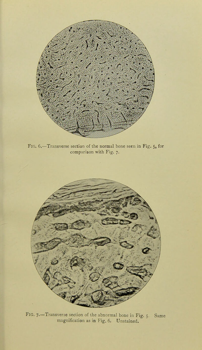 Fig. 6.—Transverse section of the normal bone seen in Fig. 5, for comparison with Fig. 7. Fig. 7.—Transverse section of the abnormal bone in Fig. 5. Same magnification as in Fig. 6. Unstained.
