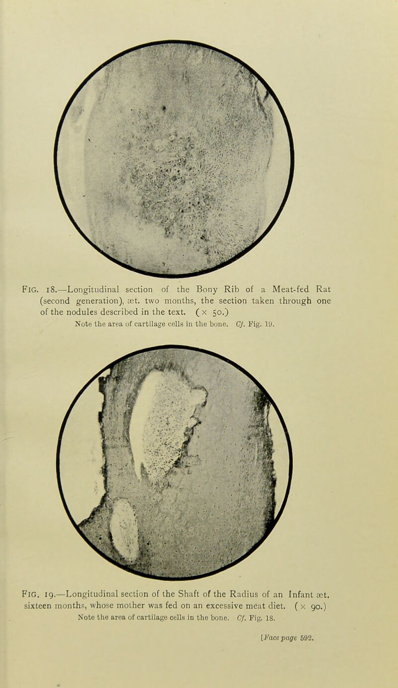 Fig. i8.—Longitudinal section of the Bony Rib of a Meat-fed Rat (second generation), set. two months, the section taken through one of the nodules described in the text. ( x 50.) Note the area of cartilage cells in tlie bone. CJ. Fig. 19. Fig. 19.—Longitudinal section of the Shaft of the Radius of an Infant oct. sixteen months, whose mother was fed on an excessive meat diet. ( x 90.) Note tlio area of cartilage cells in the bone. Cf. Fig. 18.