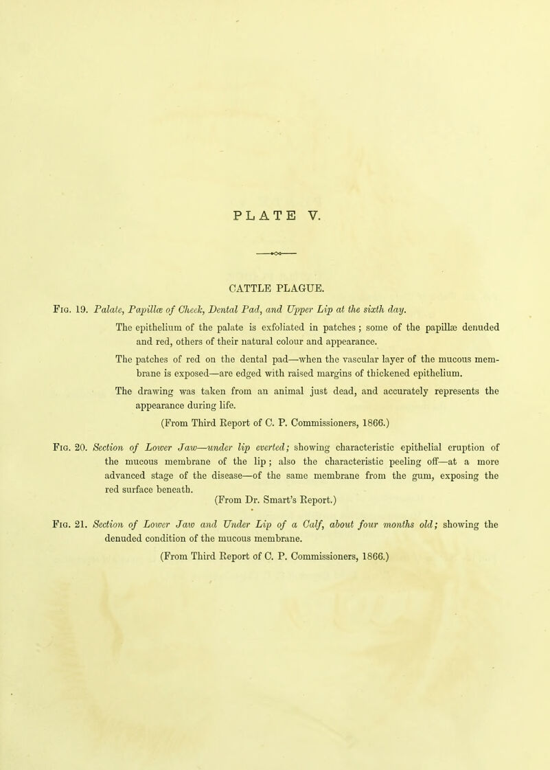 CATTLE PLAGUE. Fig. 19. Palate, Papillw of Cheek, Dental Pad, and Upper Lip at the sixth day. The eiDithelium of the palate is exfoliated in patches; some of the papillae denuded and red, others of their natural colour and appearance. The patches of red on the dental pad—when the vascular layer of the mucous mem- brane is exposed—are edged with raised margins of thickened epithelium. The drawing was taken from an animal just dead, and accurately represents the appearance during life. (From Third Report of C. P. Commissioners, 1866.) Fig. 20. Section of Lower Jaw—under lip everted; showing characteristic epithelial eruption of the mucous membrane of the lip; also the characteristic peeling oS—at a more advanced stage of the disease—of the same membrane from the gum, exposing the red surface beneath. (From Dr. Smart's Report.) Fig. 21. Section of Lower Jaw and Under Lip of a Calf, about four months old; showing the denuded condition of the mucous membrane.