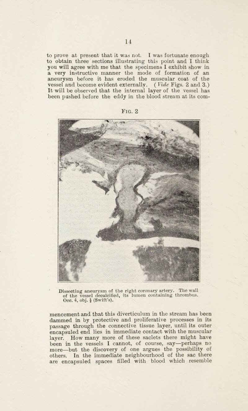 to prove at present that it was not. I was fortunate enough to obtain three sections illustrating this point and I think you will agree with me that the specimens I exhibit show in a very instructive manner the mode of formation of an aneurysm before it has eroded the muscular coat of the vessel and become evident externally. ( Vide Figs. 2 and 3.) It will be observed that the internal layer of the vessel has been pushed before the eddy in the blood stream at its com- Fig. 2 Dissecting aneurysm of the right coronary artery. The wall of the vessel decalcified, its lumen containing thrombus. Occ. 4, obj. i (Swift’s). mencement and that this diverticulum in the stream has been dammed in by protective and proliferative processes in its passage through the connective tissue layer, until its outer encapsuled end lies in immediate contact with the muscular layer. How many more of these saclets there might have been in the vessels I cannot, of course, say—perhaps no more—but the discovery of one argues the possibility of others. In the immediate neighbourhood of the sac there are encapsuled spaces filled with blood which resemble