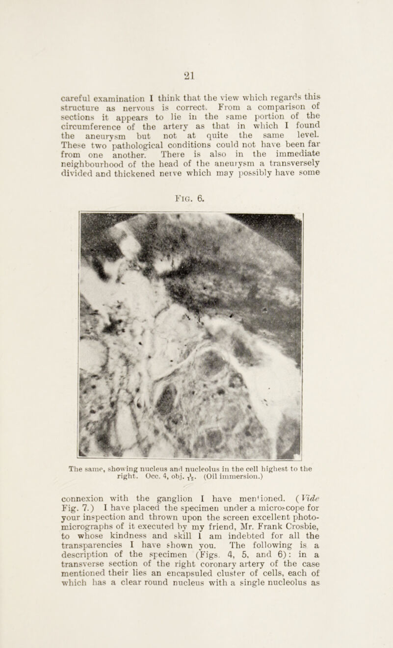 ‘21 careful examination 1 think that the view which regards thi& structure as nervous is correct. From a comparison of sections it appears to lie in the same portion of the circumference of the artery as that in which I found the aneurysm but not at quite the same level. These two pathological conditions could not have been far from one another. There is also in the immediate neighbourhood of the head of the aneurysm a transversely divided and thickened nerve which may possibly have some Fig. 6. The same, showing nucleus and nucleolus in the cell highest to the right. Occ. 4, obj. ^ (Oil immersion.) connexion with the ganglion I have men(ioned. (Vide Fig. 7.) I have placed the specimen under a microscope for your inspection and thrown upon the screen excellent photo- micrographs of it executed by my friend, Mr. Frank Crosbie, to whose kindness and skill 1 am indebted for all the transparencies I have shown you. The following is a description of the specimen (Figs. 4, 5, and 6): in a transverse section of the right coronary artery of the case mentioned their lies an encapsuled cluster of cells, each of which has a clear round nucleus with a single nucleolus as