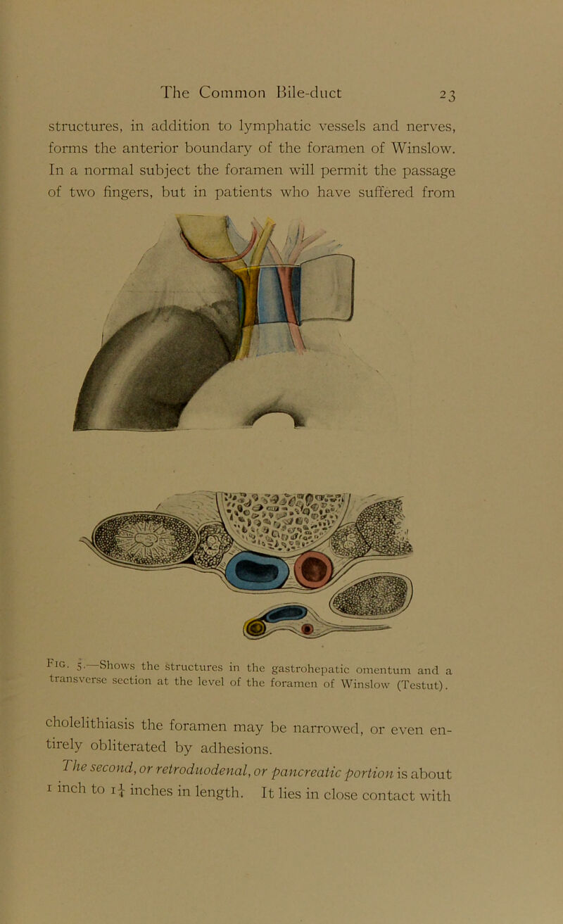 structures, in addition to lymphatic vessels and nerves, forms the anterior boundary of the foramen of Winslow. In a normal subject the foramen will permit the passage of two fingers, but in patients who have suffered from Fig. 5.—Shows the structures in the gastrohepatic omentum and a transverse section at the level of the foramen of Winslow (Testut). cholelithiasis the foramen may be narrowed, or even en- tirely obliterated by adhesions. The second, or retroduodenal, or pancreatic portion is about I inch to i-i- inches in length. It lies in close contact with