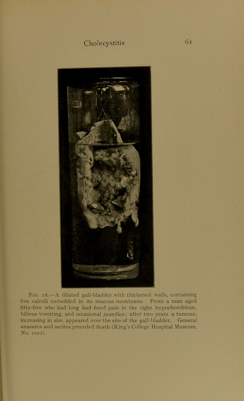 Fig. 18.—A dilated gall-bladder with thickened walls, containing five calculi embedded in its mucous membrane. From a man aged fifty-five who had long had fixed pain in the right hypochondrium, bilious vomiting, and occasional jaundice; after two years a tumour, increasing in size, appeared over the site of the gall-bladder. General anasarca and ascites preceded death (King’s College Hospital Museum, No. 1022).