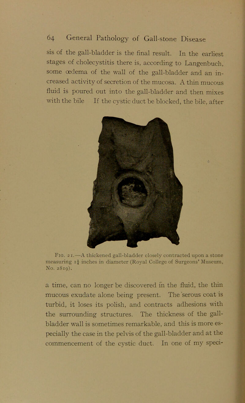 sis of the gall-bladder is the final result. In the earliest stages of cholecystitis there is, according to Langenbuch, some oedema of the wall of the gall-bladder and an in- creased activity of secretion of the mucosa. A thin mucous fluid is poured out into the gall-bladder and then mixes with the bile If the cystic duct be blocked, the bile, after Fig. 21.—A thickened gall-bladder closely contracted upon a stone measuring i J inches in diameter (Rojml College of Surgeons’ Museum, No. 2S19). a time, can no longer be discovered in the fluid, the thin mucous exudate alone being present. The serous coat is turbid, it loses its polish, and contracts adhesions with the surrounding structures. The thickness of the gall- bladder wall is sometimes remarkable, and this is more es- pecially the case in the pelvis of the gall-bladder and at the commencement of the cystic duct. In one of my speci-