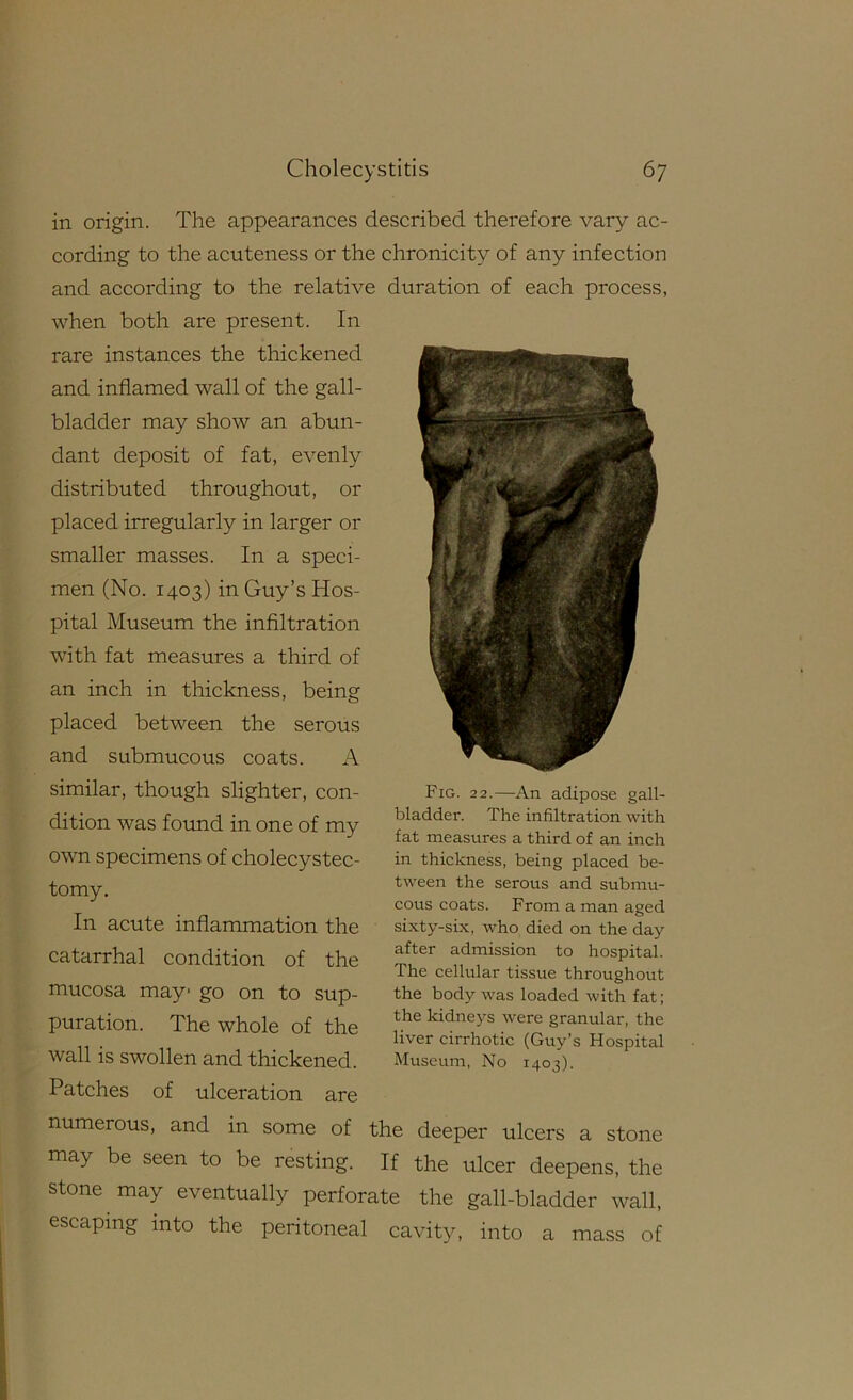 in origin. The appearances described therefore vary ac cording to the acuteness or the and according to the relative when both are present. In rare instances the thickened and inflamed wall of the gall- bladder may show an abun- dant deposit of fat, evenly- distributed throughout, or placed irregularly in larger or smaller masses. In a speci- men (No. 1403) in Guy’s Hos- pital Museum the infiltration with fat measures a third of an inch in thickness, being placed between the serous and submucous coats. A similar, though slighter, con- dition was found in one of my own specimens of cholecystec- tomy. In acute inflammation the catarrhal condition of the mucosa may go on to sup- puration. The whole of the wall is swollen and thickened. Patches of ulceration are chronicity of any infection duration of each process. Fig. 22.—An adipose gall- bladder. The infiltration with fat measures a third of an inch in thickness, being placed be- tween the serous and submu- cous coats. From a man aged sixty-sLx, who died on the day after admission to hospital. The cellular tissue throughout the body was loaded with fat; the kidneys were granular, the liver cirrhotic (Guy’s Hospital Museum, No 1403). numerous, and in some of the deeper ulcers a stone may be seen to be resting. If the ulcer deepens, the stone may eventually perforate the gall-bladder wall, escaping into the peritoneal cavity, into a mass of