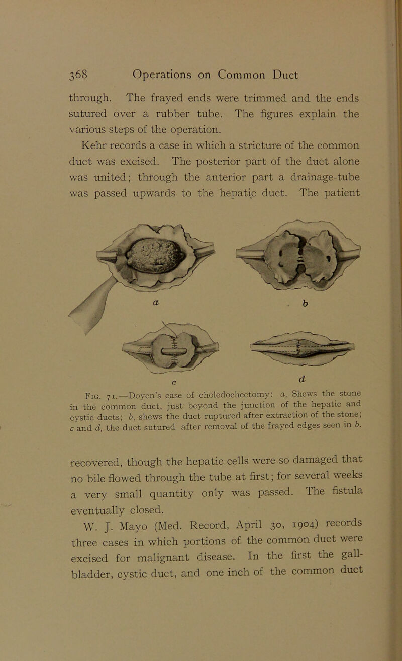 through. The frayed ends were trimmed and the ends sutured over a rubber tube. The figures explain the various steps of the operation. Kehr records a case in which a stricture of the common duct was excised. The posterior part of the duct alone was united; through the anterior part a drainage-tube was passed upwards to the hepatic duct. The patient Fig. 71.—Doyen’s case of choledochectomy: o, Shews the stone in the common duct, just beyond the junction of the hepatic and cystic ducts; b, shews the duct ruptured after extraction of the stone, c and d, the duct sutured after removal of the frayed edges seen in b. recovered, though the hepatic cells were so damaged that no bile flowed through the tube at first; for several weeks a very small quantity only was passed. The fistula eventually closed. W. J. Mayo (Med. Record, April 30, 1904) records three cases in which portions of the common duct were excised for malignant disease. In the first the gall- bladder, cystic duct, and one inch of the common duct