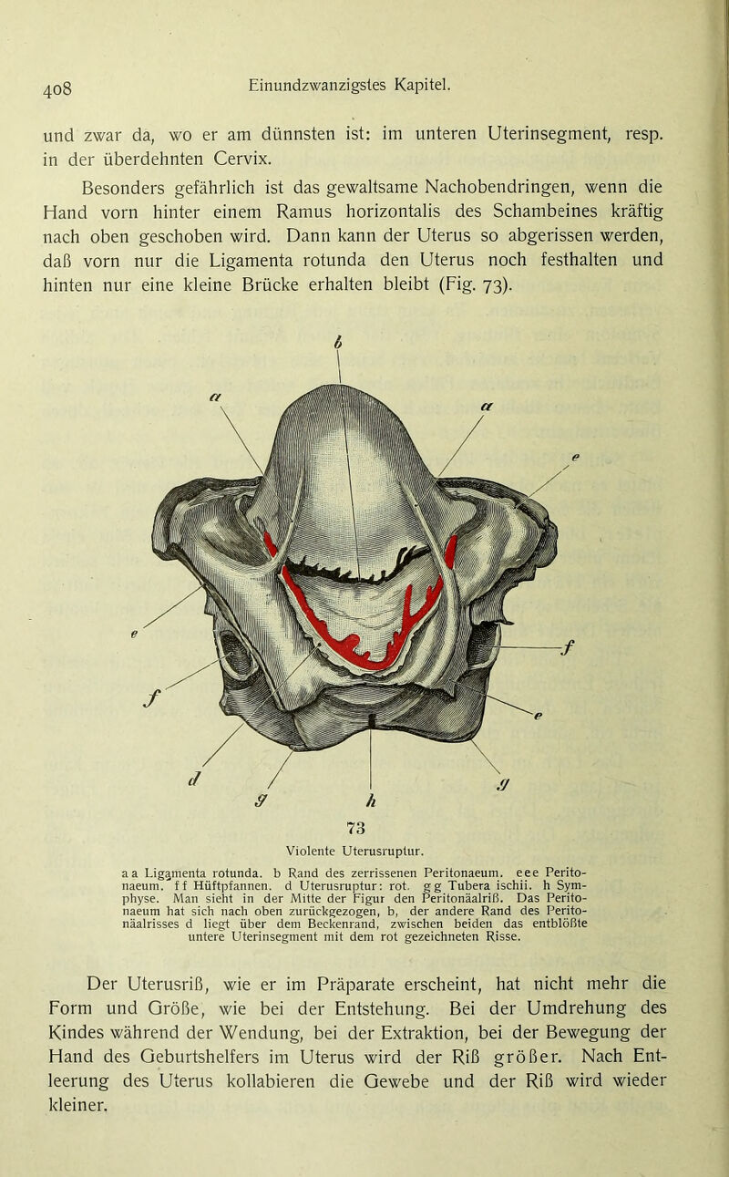 und zwar da, wo er am dünnsten ist: im unteren Uterinsegment, resp. in der überdehnten Cervix. Besonders gefährlich ist das gewaltsame Nachobendringen, wenn die Hand vorn hinter einem Ramus horizontalis des Schambeines kräftig nach oben geschoben wird. Dann kann der Uterus so abgerissen werden, daß vorn nur die Ligamenta rotunda den Uterus noch festhalten und hinten nur eine kleine Brücke erhalten bleibt (Fig. 73). b ff h 73 Violente Uterusruptur. aa Ligamenta rotunda. b Rand des zerrissenen Peritonaeum. eee Perito- naeum. ff Hüftpfannen. d Uterusruptur: rot. gg Tubera ischii. h Sym- physe. Man sieht in der Mitte der Figur den Peritonäalriß. Das Perito- naeum hat sich nach oben zurückgezogen, b, der andere Rand des Perito- näalrisses d liegt über dem Beckenrand, zwischen beiden das entblößte untere Uterinsegment mit dem rot gezeichneten Risse. Der Uterusriß, wie er im Präparate erscheint, hat nicht mehr die Form und Größe, wie bei der Entstehung. Bei der Umdrehung des Kindes während der Wendung, bei der Extraktion, bei der Bewegung der Hand des Geburtshelfers im Uterus wird der Riß größer. Nach Ent- leerung des Uterus kollabieren die Gewebe und der Riß wird wieder kleiner.