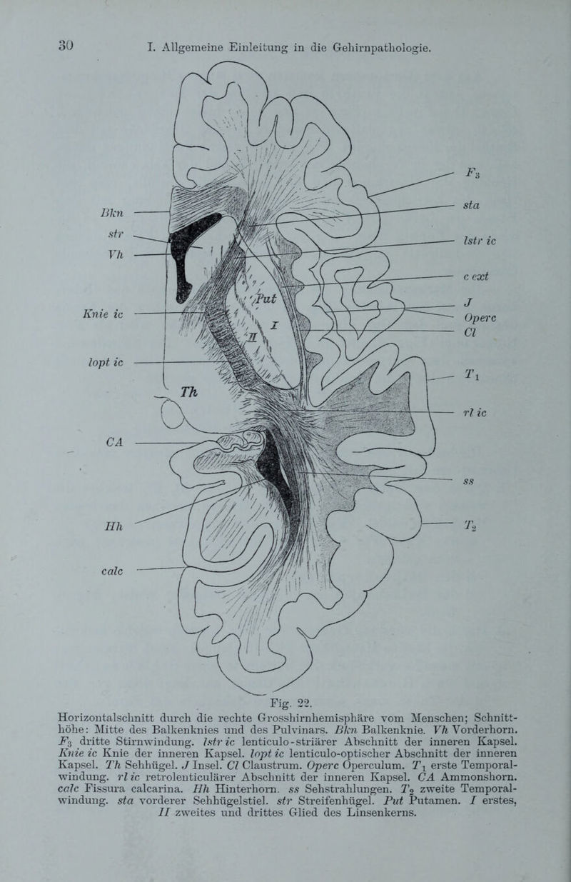 Blcn str Vh Knie ic lopt ic CA Hh calc Fig. 22. sta Istr ic c ext J Operc CI Tt rl ic T2 Horizontalschnitt durch die rechte Grosshirnhemisphäre vom Menschen; Schnitt- höhe: Mitte des Balkenknies und des Pulvinars. Bkn Balkenknie. Vh Vorderhorn. i<3 dritte Stirnwindung. Istr ic lenticulo-striärer Abschnitt der inneren Kapsel. Knie ic Knie der inneren Kapsel, lopt ic lenticulo-optischer Abschnitt der inneren Kapsel. Th Sehhügel. J Insel. CI Claustrum. Operc Operculum. Ti erste Temporal- windung. rl ic retrolenticulärer Abschnitt der inneren Kapsel. CA Ammonshorn. calc Fissura calcarina. Hh Hinterhorn, ss Sehstrahlungen. T2 zweite Temporal- windung. sta vorderer Sehhügelstiel, str Streifenhügel. Put Putamen. I erstes, II zweites und drittes Glied des Linsenkerns.