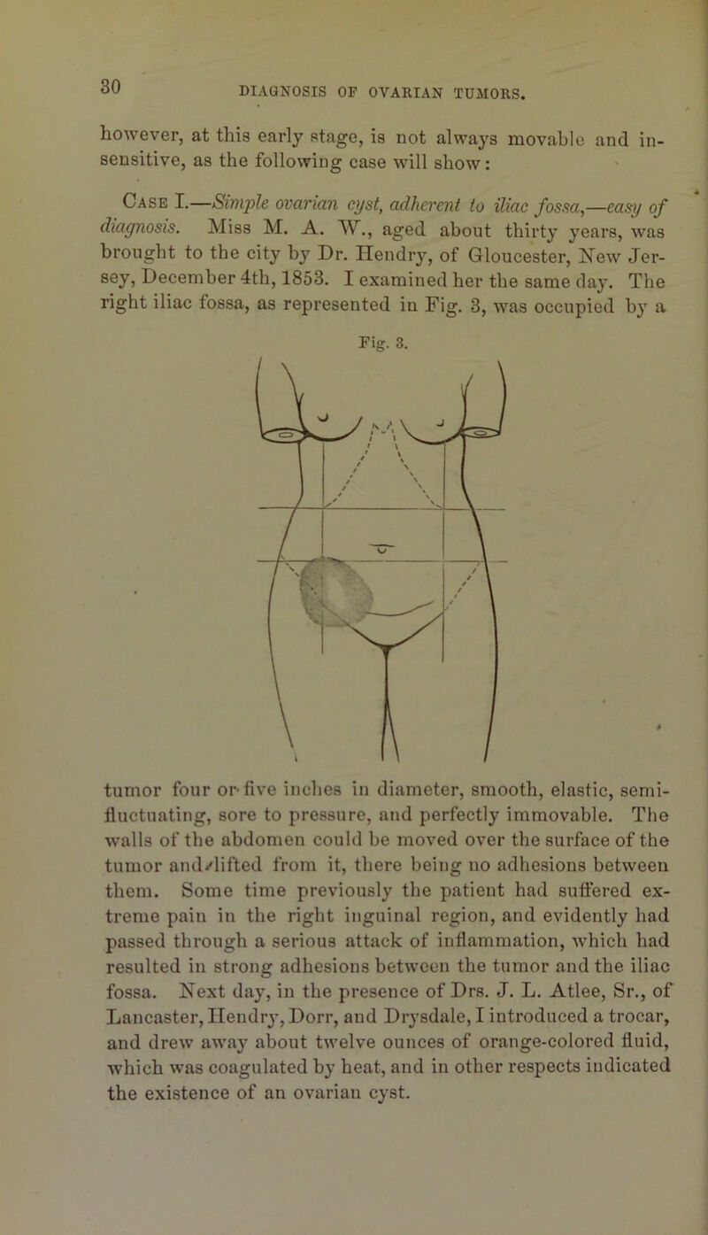 however, at this early stage, is not always movable and in- sensitive, as the following case will show: Case I.—Simple ovarian cyst, adherent to iliac fossa—easy of diagnosis. Miss M. A. W., aged about thirty years, was brought to the city by Dr. Hendry, of Gloucester, New Jer- December 4th, 1853. I examined her the same day. The right iliac fossa, as represented in Fig. 3, was occupied b}’ a tumor four or-five inches in diameter, smooth, elastic, semi- fluctuating, sore to pressure, and perfectly immovable. The w’alls of the abdomen could be moved over the surface of the tumor and/lifted from it, there being no adhesions between them. Some time previously the patient had suffered ex- treme pain in the right inguinal region, and evidently had passed through a serious attack of inflammation, which had resulted in strong adhesions between the tumor and the iliac fossa. Next day, in the presence of Drs. J. L. Atlee, Sr., of Lancaster, Ilendr}^ Dorr, and Drysdale,! introduced a trocar, and drew away about twelve ounces of orange-colored fluid, which was coagulated by heat, and in other respects indicated the existence of an ovarian cyst.