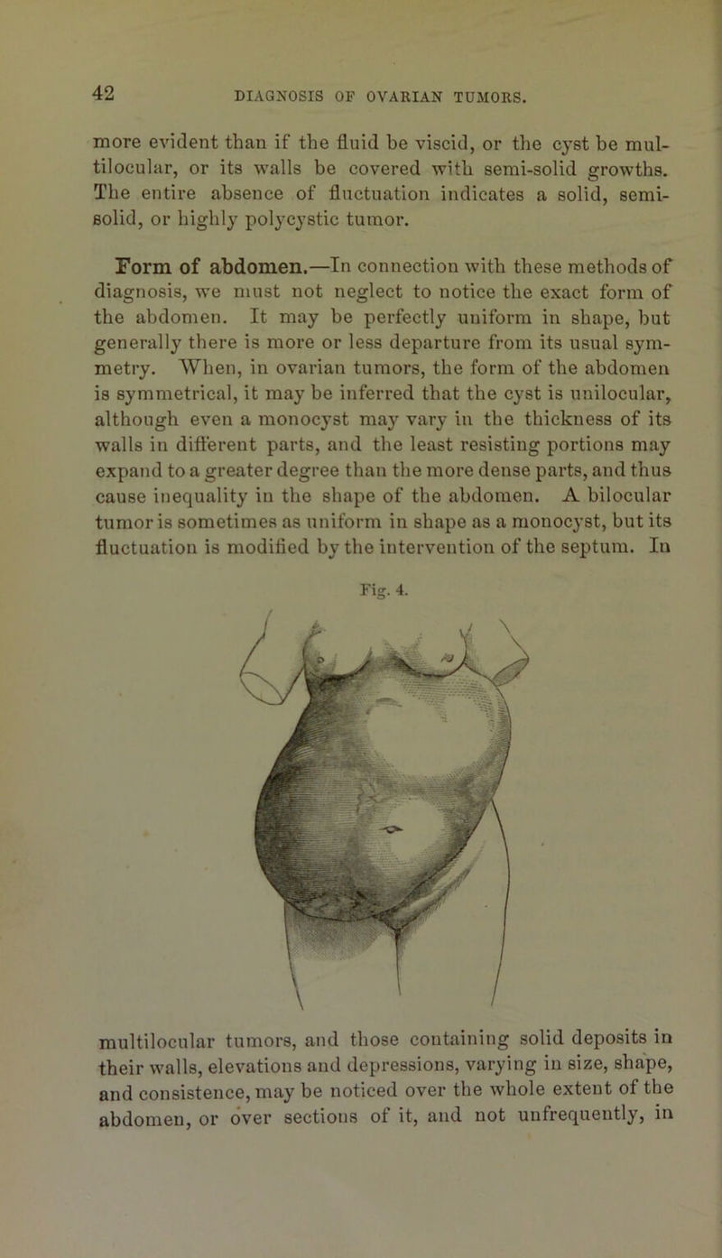 more evident than if the fluid be viscid, or tlie cyst be mul- tilocular, or its walls be covered with semi-solid growths. The entire absence of fluctuation indicates a solid, semi- solid, or highly polycystic tumor. Form of abdomen,—In connection with these methods of diagnosis, we must not neglect to notice the exact form of the abdomen. It may be perfectly uniform in shape, hut generally there is more or less departure from its usual sym- metry. When, in ovarian tumors, the form of the abdomen is symmetrical, it may be inferred that the cyst is unilocular, although even a monocyst may vary in the thickness of its walls in different parts, and the least resisting portions may expand to a greater degree than the more dense parts, and thus cause inequality in the shape of the abdomen. A bilocular tumor is sometimes as uniform in shape as a monocyst, but its fluctuation is modified by the intervention of the septum. In Fig. 4. multilocular tumors, and those containing solid deposits in their walls, elevations and depressions, varying in size, shape, and consistence, may be noticed over the whole extent of the abdomen, or over sections of it, and not unfrequently, in