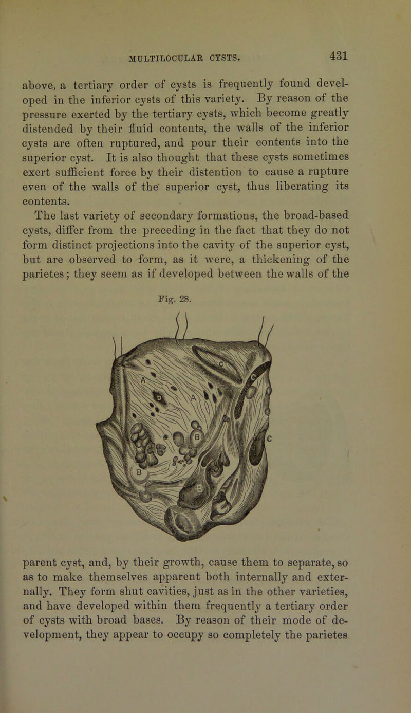 above, a tertiary order of cysts is frequently found devel- oped in the inferior cysts of this variety. By reason of the pressure exerted the tertiary cysts, which become greatly distended by their fluid contents, the walls of the inferior cysts are often ruptured, and pour their contents into the superior cyst. It is also thought that these cysts sometimes exert sufficient force by their distention to cause a rupture even of the walls of the superior cyst, thus liberating its contents. The last variety of secondary formations, the broad-based cysts, differ from the preceding in the fact that they do not form distinct projections into the cavity of the superior cyst, but are observed to form, as it were, a thickening of the parietes; they seem as if developed between the walls of the Fig. 28. parent cyst, and, by their growth, cause them to separate, so as to make themselves apparent both internally and exter- nally. They form shut cavities, just as in the other varieties, and have developed within them frequently a tertiary order of cysts with broad bases. By reason of their mode of de- velopment, they appear to occupy so completely the parietes