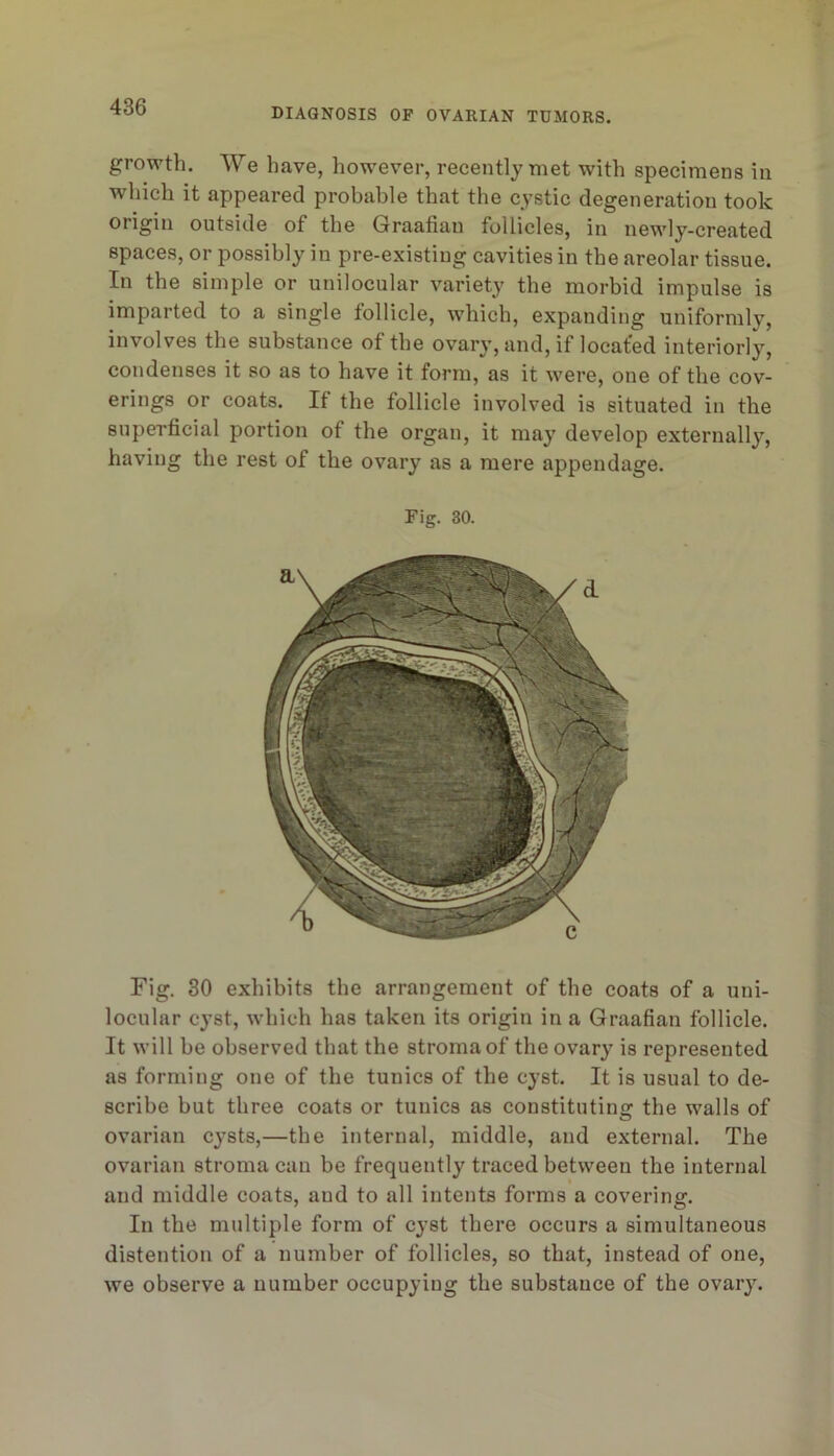 growth. We have, however, recently met with specimens in which it appeared probable that the cystic degeneration took origin outside of the Graafian follicles, in newly-created spaces, or possibly in pre-existing cavities in the areolar tissue. In the simple or unilocular variety the morbid impulse is imparted to a single follicle, which, expanding uniformly, involves the substance of the ovary, and, if located interiorly, condenses it so as to have it form, as it were, one of the cov- erings or coats. If the follicle involved is situated in the superficial portion of the organ, it may develop externally, having the rest of the ovary as a mere appendage. Fig. 30. Fig. 30 exhibits the arrangement of the coats of a uni- locular cyst, which has taken its origin in a Graafian follicle. It will be observed that the stroma of the ovary is represented as forming one of the tunics of the cyst. It is usual to de- scribe but three coats or tunics as constitutins: the walls of ovarian cysts,—the internal, middle, and external. The ovarian stroma cun be frequently traced between the internal and middle coats, and to all intents forms a covering. In the multiple form of cyst there occurs a simultaneous distention of a number of follicles, so that, instead of one, we observe a number occupying the substance of the ovary.