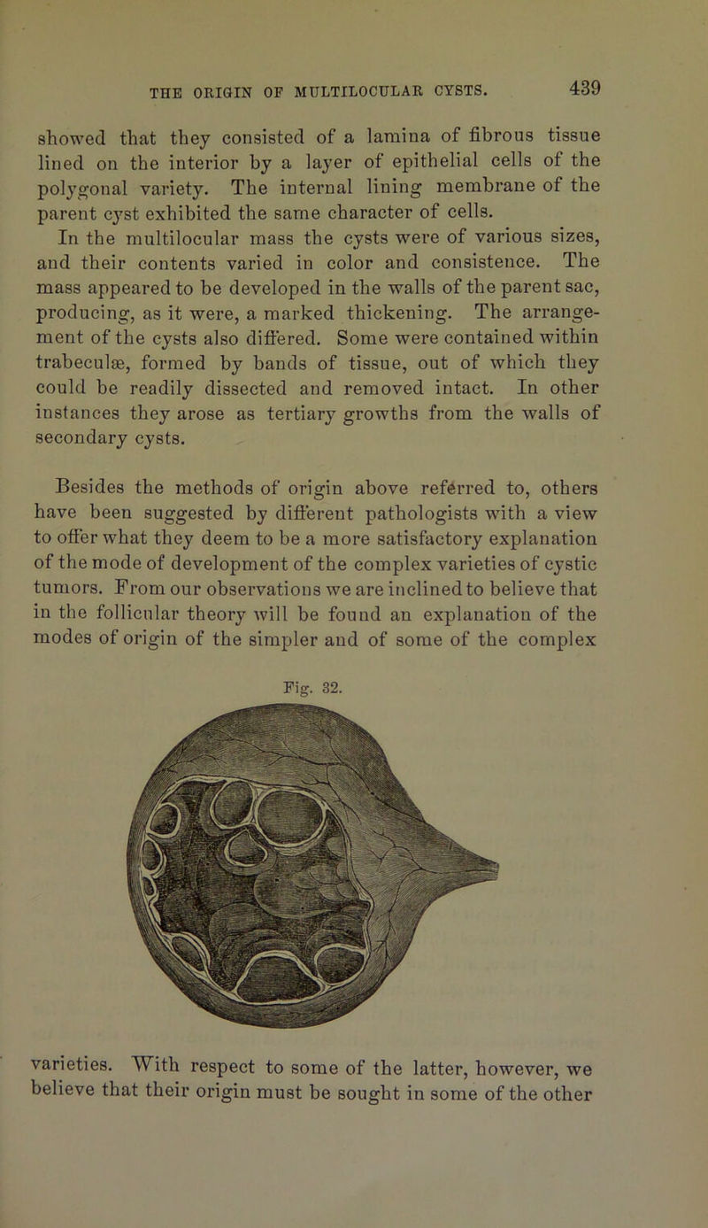 showed that they consisted of a lamina of fibrous tissue lined on the interior by a layer of epithelial cells of the polygonal variety. The internal lining membrane of the parent cyst exhibited the same character of cells. In the multilocular mass the cysts were of various sizes, and their contents varied in color and consistence. The mass appeared to be developed in the walls of the parent sac, producing, as it were, a marked thickening. The arrange- ment of the cysts also diftered. Some were contained within trabeculae, formed by bands of tissue, out of which they could be readily dissected and removed intact. In other instances they arose as tertiary growths from the walls of secondary cysts. Besides the methods of origin above referred to, others have been suggested by difterent pathologists with a view to offer what they deem to be a more satisfactory explanation of the mode of development of the complex varieties of cystic tumors. From our observations we are inclined to believe that in the follicular theory will be found an explanation of the modes of origin of the simpler and of some of the complex Fig. 32. varieties. With respect to some of the latter, however, we believe that their origin must be sought in some of the other