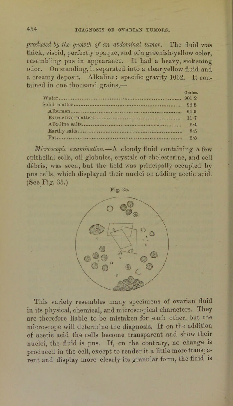 'produced hy the growth of an abdominal tumor. The fluid was thick, viscid, perfectly opaque, and of a greenish-yellow color, resembling pus in appearance. It had a heavy, sickening odor. On standing, it separated into a clear yellow fluid and a creamy deposit. Alkaline; specific gravity 1032. It con- tained in one thousand grains,— Grains. Water 901-2 Solid matter 98-8 Albumen G4-9 Extractive matters 11-7 Alkaline salts 6-4 Earthy salts 8-5 Eat 6-6 31ieroscopic examination.—A cloudy fluid containing a few epithelial cells, oil globules, crystals of cholesterine, and cell debris, was seen, but the field was principally occupied by pus cells, which displayed their nuclei on adding acetic acid. (See Fig. 35.) Fig. 35. This variety resembles many specimens of ovarian fluid in its physical, chemical, and microscopical characters. They are therefore liable to be mistaken for each other, but the microscope will determine the diagnosis. If on the addition of acetic acid the cells become transparent and show their nuclei, the fluid is pus. If, on the contrary, no change is produced in the cell, except to render it a little more transpa- rent and display more clearly its granular form, the fluid is