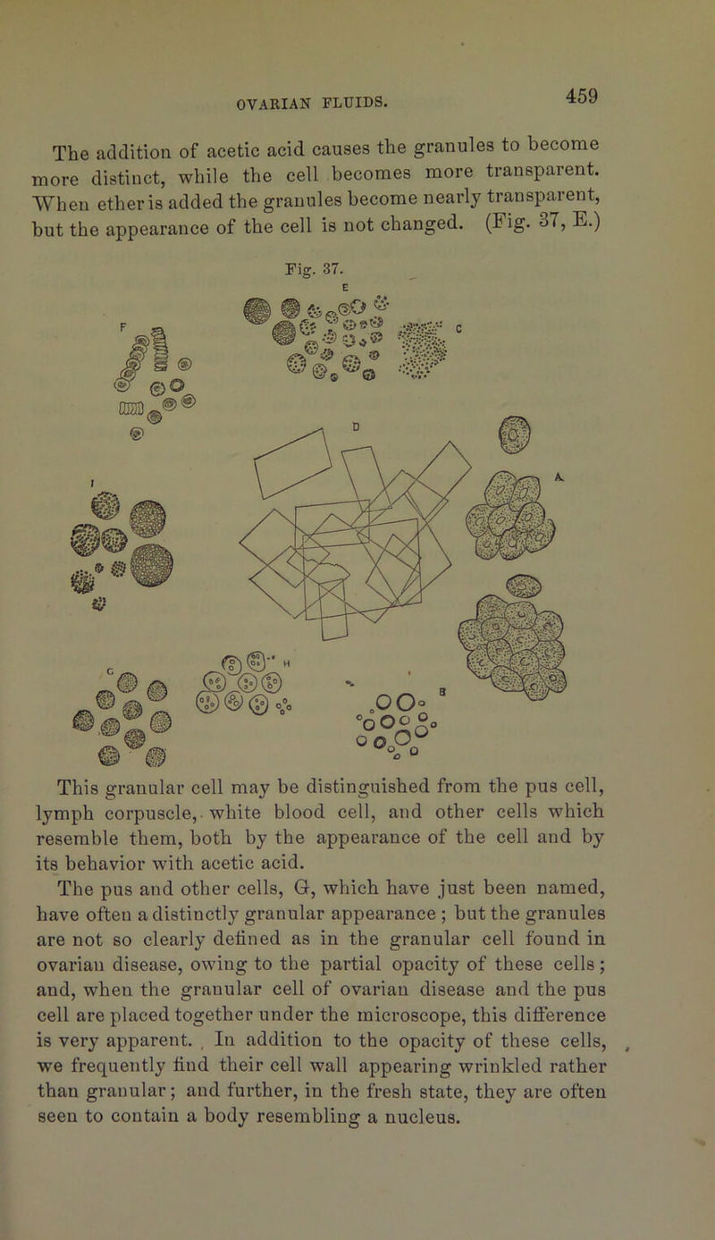 The addition of acetic acid causes the granules to become more distinct, while the cell becomes more transparent. ■\Vhen ether is added the granules become nearly transparent, but the appearance of the cell is not changed. (Fig. 37, E.) Fig. 37. E This granular cell may be distinguished from the pus cell, lymph corpuscle,, white blood cell, and other cells which resemble them, both by the appearance of the cell and by its behavior with acetic acid. The pus and other cells, Q-, which have just been named, have often a distinctly granular appearance ; but the granules are not so clearly defined as in the granular cell found in ovarian disease, owing to the partial opacity of these cells; and, when the granular cell of ovarian disease and the pus cell are placed together under the microscope, this diflerence is very apparent. , In addition to the opacity of these cells, we frequently find their cell wall appearing wrinkled rather than granular; and further, in the fresh state, they are often seen to contain a body resembling a nucleus.