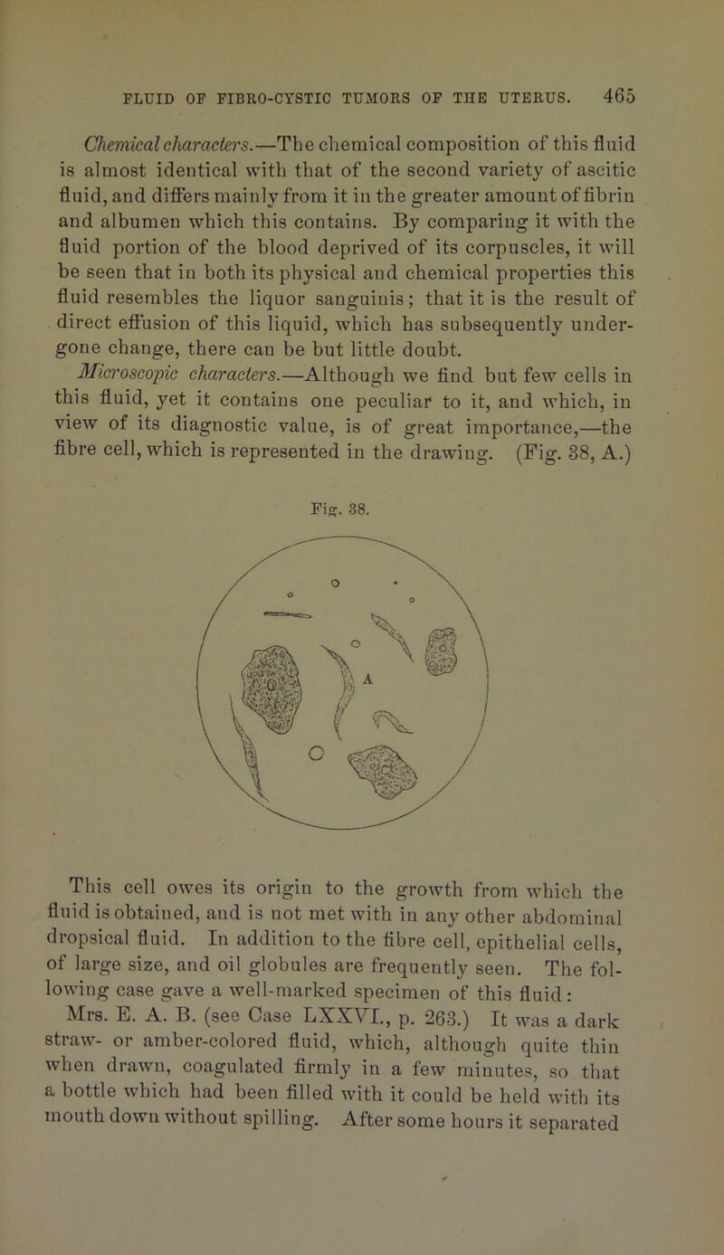 Chemical characters.—The chemical composition of this fluid is almost identical with that of the second variety of ascitic fluid, and difters mainly from it in the greater amount of fibrin and albumen which this contains. By comparing it with the fluid portion of the blood deprived of its corpuscles, it will be seen that in both its physical and chemical properties this fluid resembles the liquor sanguinis; that it is the result of direct effusion of this liquid, which has subsequently under- gone change, there can be but little doubt. Microscopic characters.—Although we find but few cells in this fluid, yet it contains one peculiar to it, and which, in view of its diagnostic value, is of great importance,—the fibre cell, which is represented in the drawing. (Fig. 38, A.) Fig. 38. This cell owms its origin to the growth from which the fluid is obtained, and is not met with in any other abdominal dropsical fluid. In addition to the fibre cell, epithelial cells, of large size, and oil globules are frequently seen. The fol- lowing case gave a well-marked specimen of this fluid : Mrs. E. A. B. (see Case LXXVL, p. 263.) It was a dark straw- or amber-colored fluid, which, although quite thin when drawn, coagulated firmly in a few minutes, so that a bottle which had been filled with it could be held with its mouth down without spilling. After some hours it separated