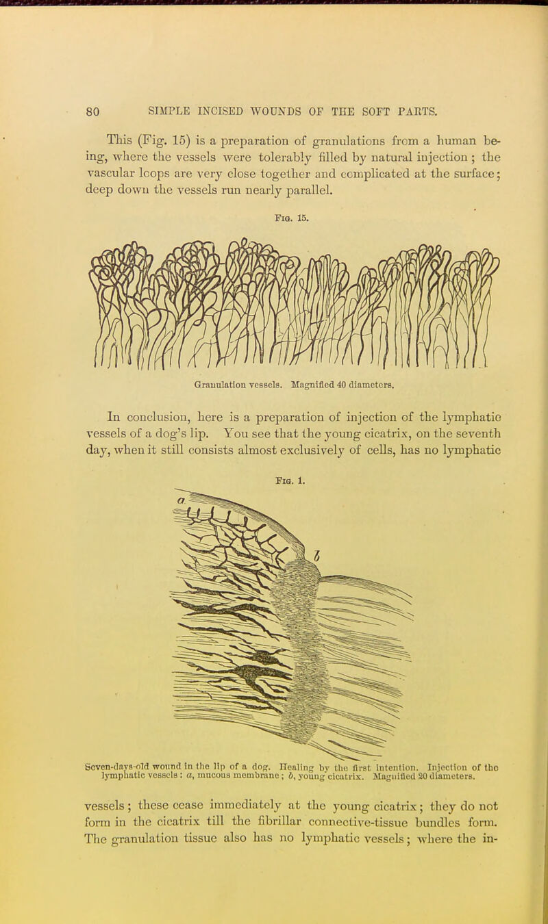 This (Fig. 15) is a preparation of granulations from a human be- ing, where the vessels were tolerably filled by natural injection ; the vascular loops are very close together and complicated at the surface; deep down the vessels nm nearly parallel. FiQ. 15. Granulation vessels. Magnified 40 diameters. In conclusion, here is a preparation of injection of the lymphatic vessels of a dog's lip. You see that the young cicatrix, on the seventh day, when it still consists almost exclusively of cells, has no lymphatic Fia. 1. Scven-davs-old wound in the lip of a dog. ITealing by Uu; first intention. Inioction of tho lymphatic vessels : a, mucous membrane ; 6, young ciaitri.\. Magnified 20 diameters. vessels ; these cease immediately at the young cicatrix; they do not form in the cicatrix till the fibrillar connective-tissue bundles form. The granulation tissue also has no lymphatic vessels; Avhere the in-