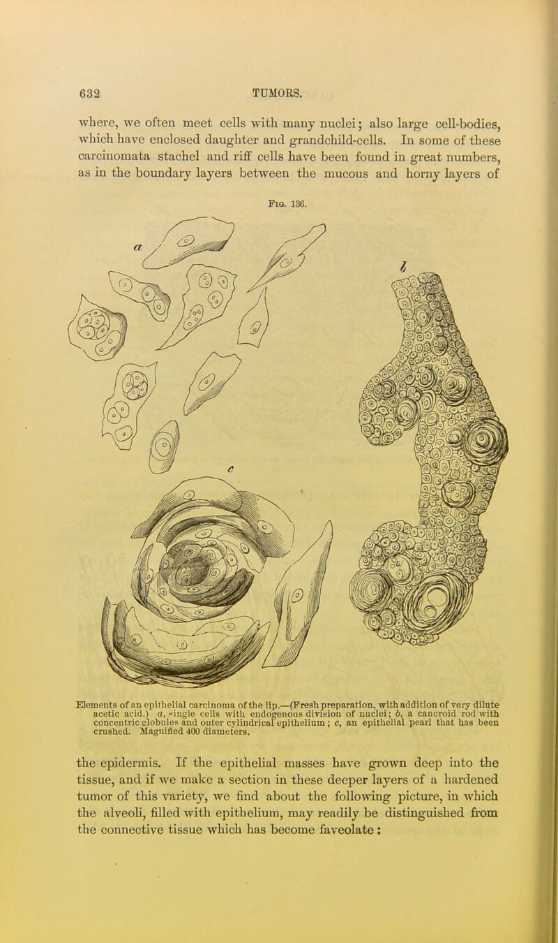 where, we often meet cells with many nuclei; also large cell-bodies, which have enclosed daughter and grandchild-cells. In some of these carcinomata stachel and riff cells have been found in great numbers, as in the boundary layers between the mucous and horny layers of PlO. 136. Elements of an epithelial carcinoma of the lip.—(Fresh preparation, with addition of very dilate acetic acid.) a, niugle cells with endogenoiis division of nuclei; b, a cancroid rod with concentric clobules and outer cylindricalepithelium; c, an epithelial pearl that has been crushed. Magnified 400 diameters. the epidermis. If the epithelial masses have gro^vn deep into the tissue, and if we make a section in these deeper layers of a hardened tumor of this variety, we find about the following picture, in which the alveoli, filled with epithelium, may readily be distinguished irom the connective tissue which has become faveolate: