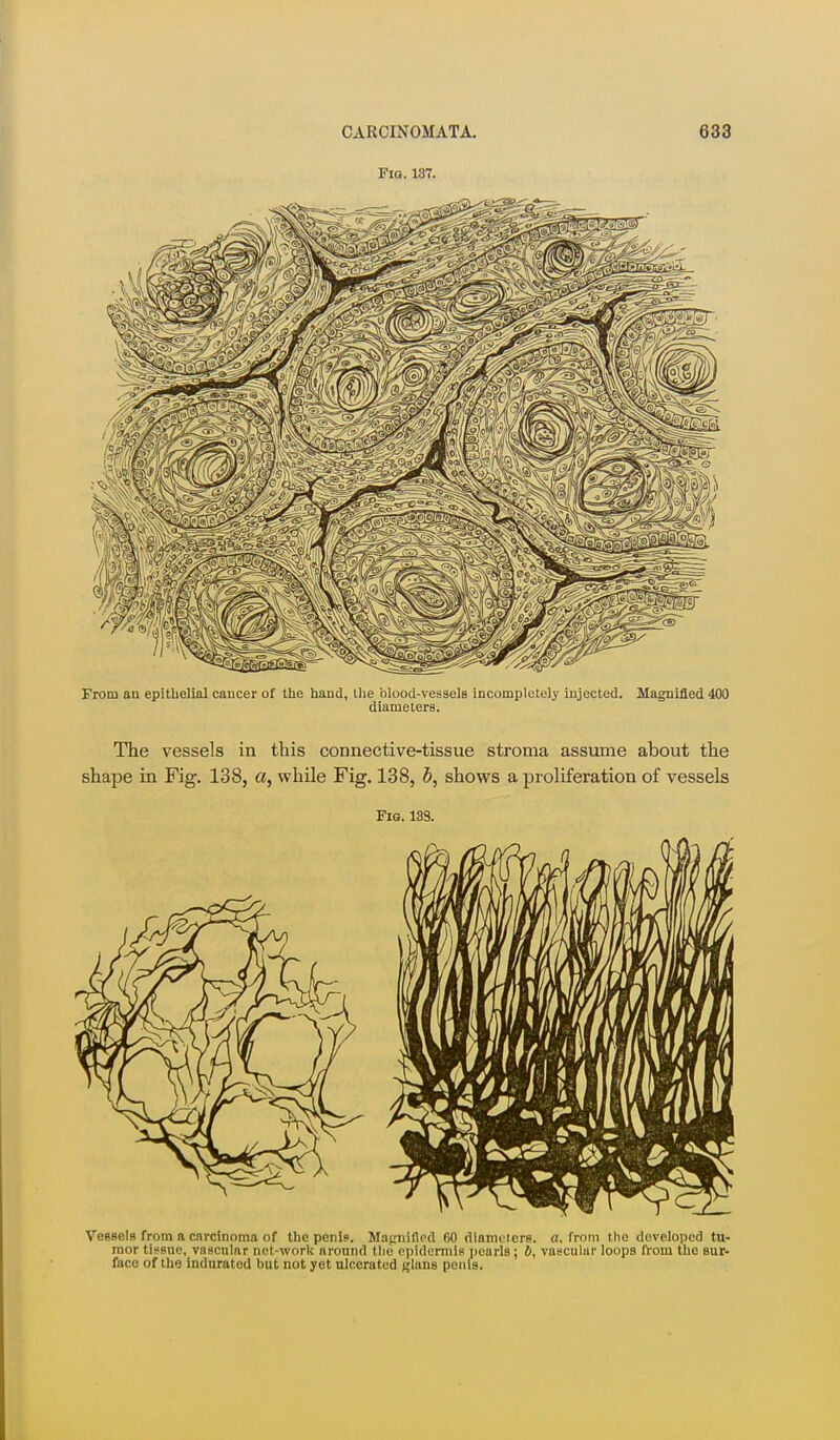 Fio. 137. From au epithelial cancer of the hand, llie blood-vessels incompletely injected. Magnified 400 diameters. The vessels in this connective-tissue stroma assume about the shape in Fig. 138, a, while Fig. 138, h, shows a proliferation of vessels Fig. 133. Vessels from a carcinoma of the penis. Mafrnifled f)0 diamuters. o, from the developed tu- mor tii^Buc, vascular net-work aronnd the epidcrmlB pearls; J, vascular loops from the sur- face of the indurated but not yet ulcerated glans poiiis.