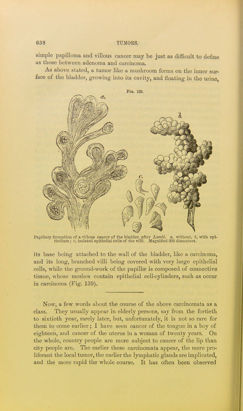 simple papilloma and villous cancer may be just as difficult to define as those between adenoma and carcinoma. As above stated, a tumor like a mushroom forms on the inner sur- face of the bladder, growing into its cavity, and floating in the m-ine, Fig. 189. Papillary formation of a villonB cancer of the bladder, after Lambl. a, without, b, with epi- thelium ; c, isolated epithelial cells of the villi. Magnified 350 diameters. its base being attached to the wall of the bladder, like a carcinoma, and its long, branched villi being covered with very large epithelial cells, while the ground-work of the papillie is composed of connective tissue, whose meshes contain epiithelial cell-cylinders, such as occur in carcinoma (Fig. 139). Now, a few words about the course of the above carcinomata as a class. They usually appear in elderly persons, say from the fortieth to sixtieth year, rarely later, but, unfortunately, it is not so rare for them to come earlier; I have seen cancer of the tongue in a boy of eighteen, and cancer of the uterus in a woman of twenty years. On the whole, country people are more subject to cancer of the lip tlian city people are. The earlier these carcinomata appear, the more pro- liferant the local tumor, the earlier the lymphatic glands are implicated, and the more rapid the whole course. It has often been observed