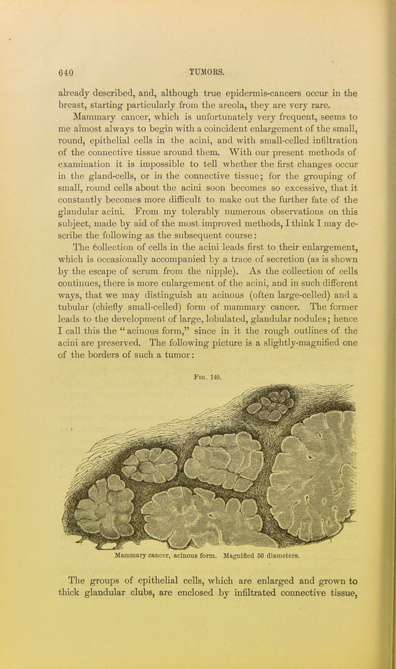 already described, and, although true epidermis-cancers occur in the breast, starting particularly from the areola, they are ver}- rare. Mammary cancer, which is unfortunately very frequent, seems to me almost always to begin with a coincident enlargement of the small, round, epithelial cells in the acini, and with small-celled infiltration of the connective tissue around them. With our present methods of examination it is impossible to tell whether the first changes occur in the gland-cells, or in the connective tissue; for the grouping of small, round cells about the acini soon becomes so excessive, that it constantly becomes more diflScult to make out the further fate of the glandular acini. From my tolerably numerous observations on this subject, made by aid of the most improved methods, I think I may de- scribe the following as the subsequent course: The collection of cells in the acini leads first to their enlargement, which is occasionally accompanied by a trace of secretion (as is sho-wTi by the escape of serum from the nipple). As the collection of cells continues, there is more enlargement of the acini, and in such different ways, that we may distinguish an acinous (often large-celled) and a tubular (chiefly small-celled) form of mammary cancer. The former leads to the development of large, lobulated, glandular nodules; hence I call this the  acinous form, since in it the rough outlines of the acini are preserved. The following picture is a slightly-magnified one of the borders of such a tumor: Fig. 140. Mammary cancer, acinoas form. Magnified 60 diameters. The groups of epithelial cells, which are enlarged and grown to thick glandular clubs, are enclosed by infiltrated connective tissue,