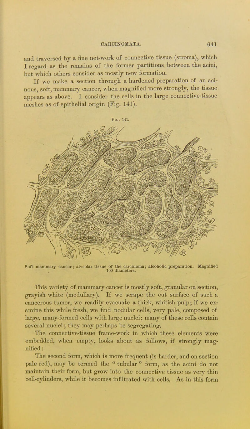 and traversed by a fine net-work of connective tissue (stroma), which I regard as the remains of the former partitions between the acini, but which others consider as mostly new formation. If we make a section through a hardened preparation of an aci- nous, soft, mammary cancer, when magnified more strongly, the tissue appears as above. I consider the cells in the large connective-tissue meshes as of epithelial origin (Fig. 141). Fig. 141. Soft mammary cancer; alveolar tissue of the carcinoma; alcoholic preparation. Magnified 100 diameters. This variety of mammary cancer is mostly soft, granular on section, grayish white (medullary). If we scrape the cut surface of such a cancerous tumor, we readily evacuate a thick, whitish pulp; if we ex- amine this while fresh, we find nodular cells, very pale, composed of large, many-formed cells with large nuclei; many of these cells contain several nuclei; they may perhaps be segregating. The connective-tissue frame-work in which these elements were embedded, when empty, looks about as follows, if strongly mag- nified : The second form, which is more frequent (is harder, and on section pale red), may be termed the  tubular  form, as the acini do not maintain their form, but grow into the connective tissue as very thin cell-cylinders, while it becomes infiltrated with cells. As in this form