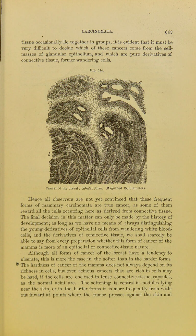 * tissue occasionally lie together in groups, it is evident that it must be very difficult to decide which of these cancers come from the cell- masses of glandular epithelium, and which are pure derivatives of connective tissue, former wandering cells. Fio. 144. Cancer of the breast; tnbu]ar form. Magnified 150 diameters. Hence all observers are not yet convinced that these frequent forms of mammary carcinomata are true cancer, as some of them regard all the cells occurring here as derived from connective tissue. The final decision in this matter can only be made by the history of development; as long as we have no means of always distinguishing the young derivatives of epithelial cells from wandering white blood- cells, and the derivatives of connective tissue, we shall scarcely be able to say from every preparation whether this form of cancer of the mamma is more of an epithelial or connective-tissue nature. Although all forms of cancer of the breast have a tendency to ulcerate, this is more the case in the softer than in the harder fonns. ^ The hardness of cancer of the mamma does not always depend on its richness in cells, but even acinous cancers that are rich in cells may be hard, if the cells are enclosed in tense connective-tissue capsules, as the normal acini are. The softening is central in nodules lying near the skin, or in the harder forms it is more frequently from with- out inward at points where the tumor presses against the skin and