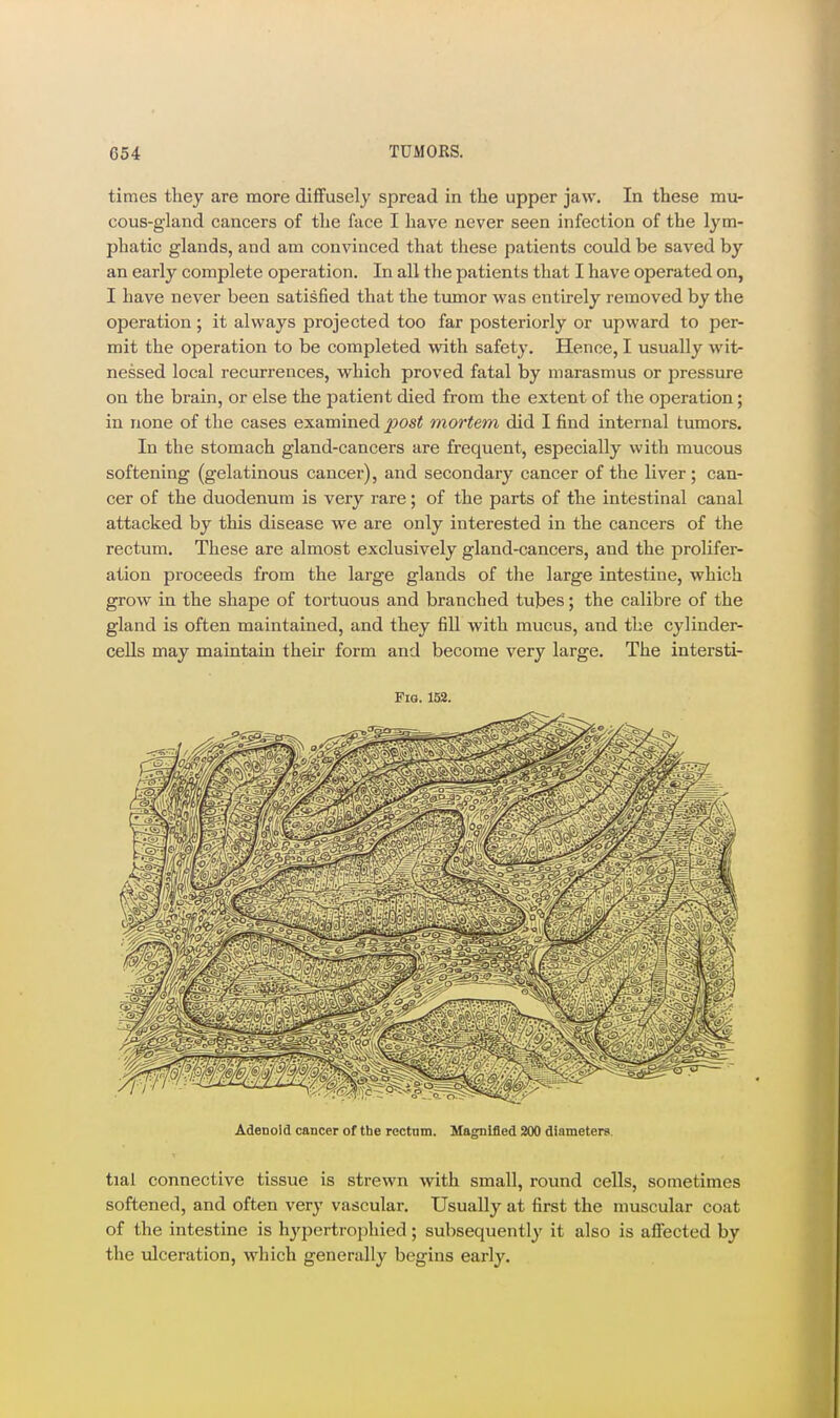 times they are more diffusely spread in the upper jaw. In these mu- cous-gland cancers of the face I have never seen infection of the lym- phatic glands, and am convinced that these patients could be saved by an early complete operation. In all the patients that I have operated on, I have never been satisfied that the tumor was entirely removed by the operation ; it always projected too far posteriorly or upward to per- mit the operation to be completed with safety. Hence, I usually wit- nessed local recurrences, which proved fatal by marasmus or pressure on the brain, or else the patient died from the extent of the operation; in none of the cases examined post mortem did I find internal tumors. In the stomach gland-cancers are frequent, especially with mucous softening (gelatinous cancer), and secondary cancer of the liver ; can- cer of the duodenum is very rare; of the parts of the intestinal canal attacked by this disease we are only interested in the cancers of the rectum. These are almost exclusively gland-cancers, and the prolifer- ation proceeds from the large glands of the large intestine, which grow in the shape of tortuous and branched tubes; the calibre of the gland is often maintained, and they fill with mucus, and the cylinder- cells may maintain their form and become very large. The intersti- Fia. 152. Adeoold cancer of the rectnm. Magnified 200 diameters. tial connective tissue is strewn with small, round cells, sometimes softened, and often very vascular. Usually at first the muscular coat of the intestine is hyi3ertroi)hied; subsequently it also is affected by the ulceration, which generally begins early.